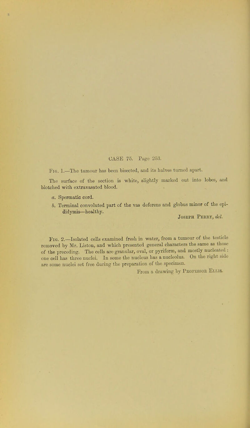 YxG. 1.—The tumour has been bisected, and its halves turned apart. The surface of the section is white, slightly marked out into lobes, and blotched with extravasated blood. a. Spermatic cord. b. Terminal convoluted part of the vas deferens and globus minor of the epi- didymis—healthy. Joseph Perky, del. Fig. 2.—Isolated cells examined fresh in water, from a tumour of the testicle removed by Mr. Listen, and which presented general characters the same as those of the preceding. The cells are granular, oval, or pyriform, and mostly nucleated : one cell has three nuclei. In some the nucleus has a nucleolus. On the right side are some nuclei set free during the preparation of the specimen. From a drawing by rKorESSOK Ellis. I