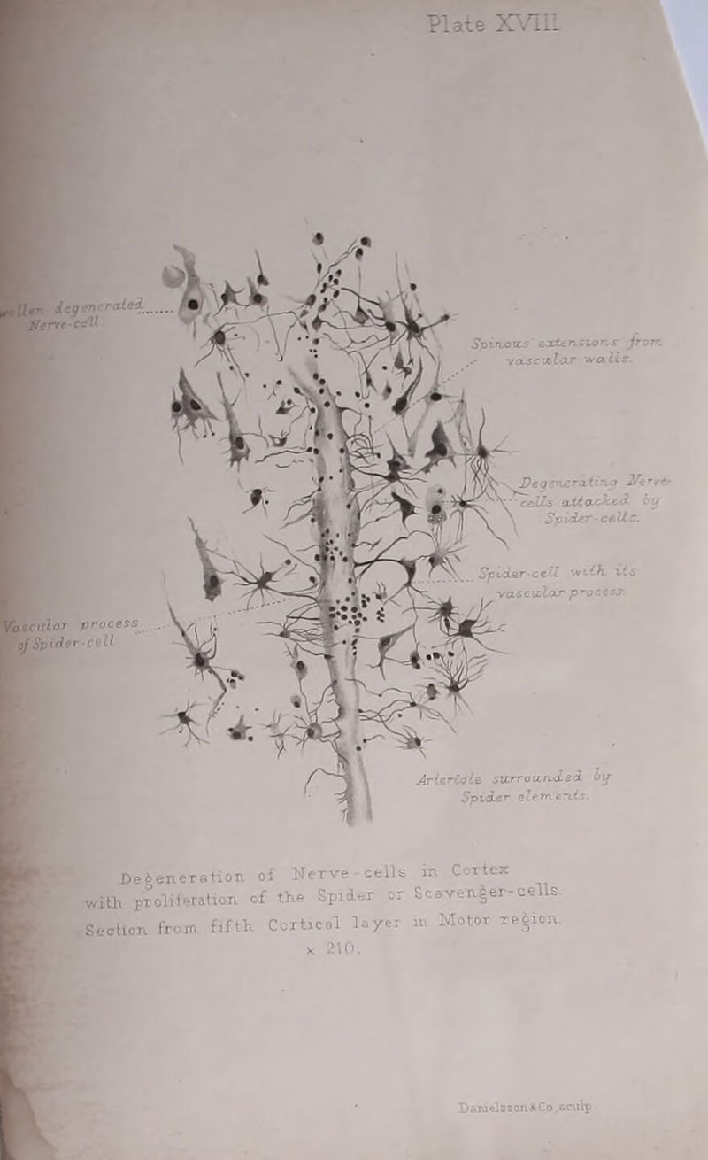 Va9Cltlor process [ of Spider cell D •: ] ' ■ - - ‘ ~celLs oxto-ckcd. Pt/ Spider-cells. SpLder-cc.il vrclh id* ■vascular process ArierCoie. surrounded iif Spider eleme~iis- Deiencration of Meivt cells in Cortex with proliferation of the Spider or Scavenger-cells Section from fifth Cortical layer in Motor region, x 210. Dariielsson^Co .nculp