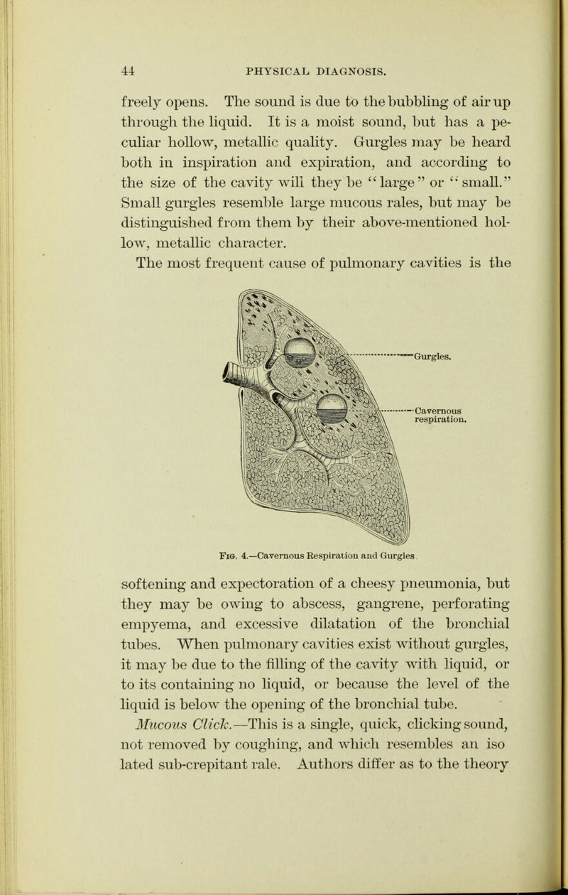 freely opens. The sound is due to the bubbhng of air up through the hquid. It is a moist sound, but has a pe- cuhar hollow, metallic quality. Gurgles may be heard both in inspiration and expiration, and according to the size of the cavity will they be large or small. Small gurgles resemble large mucous rales, but may be distinguished from them by their above-mentioned hol- low, metallic character. The most frequent cause of pulmonary cavities is the Fig. 4.—Cavernous Respiration and Gurgles softening and expectoration of a cheesy pneumonia, but they may be owing to abscess, gangrene, perforating empyema, and excessive dilatation of the bronchial tubes. When pulmonary cavities exist without gurgles, it may be due to the filling of the cavity with liquid, or to its containing no liquid, or because the level of the liquid is below the opening of the bronchial tube. Mucous Click.—This is a single, quick, clicking sound, not removed by coughing, and which resembles an iso lated sub-crepitant rale. Authors differ as to the theory