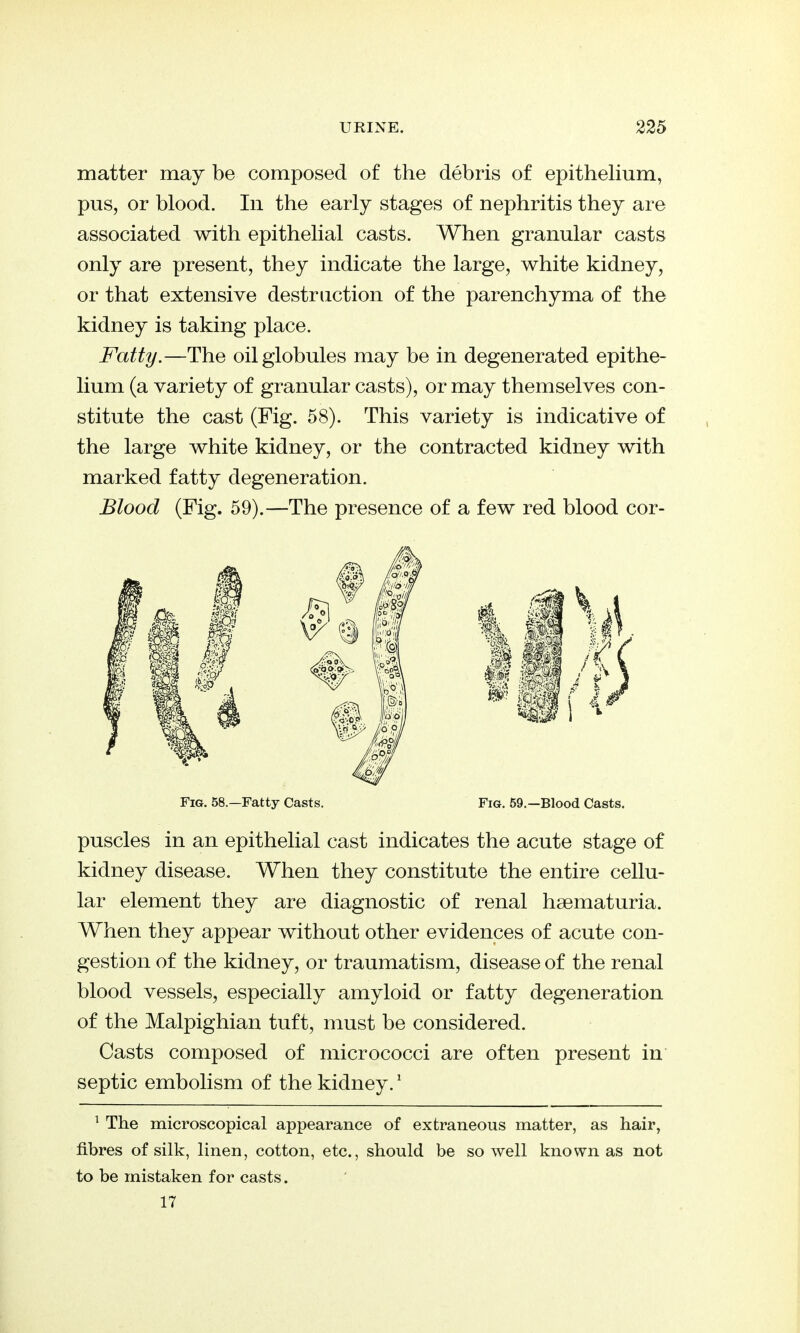 matter may be composed of the debris of epithelium, pus, or blood. In the early stages of nephritis they are associated with epithelial casts. When granular casts only are present, they indicate the large, white kidney, or that extensive destruction of the parenchyma of the kidney is taking place. Fatty.—The oil globules may be in degenerated epithe- lium (a variety of granular casts), or may themselves con- stitute the cast (Fig. 58). This variety is indicative of the large white kidney, or the contracted kidney with marked fatty degeneration. Blood (Fig. 59).—The presence of a few red blood cor- puscles in an epithelial cast indicates the acute stage of kidney disease. When they constitute the entire cellu- lar element they are diagnostic of renal haematuria. When they appear without other evidences of acute con- gestion of the kidney, or traumatism, disease of the renal blood vessels, especially amyloid or fatty degeneration of the Malpighian tuft, must be considered. Casts composed of micrococci are often present in septic embolism of the kidney.' ^ The microscopical appearance of extraneous matter, as hair, fibres of silk, linen, cotton, etc., should be so well known as not to be mistaken for casts. 17 Fig. 58.—Fatty Casts. Fig. 59.—Blood Casts.