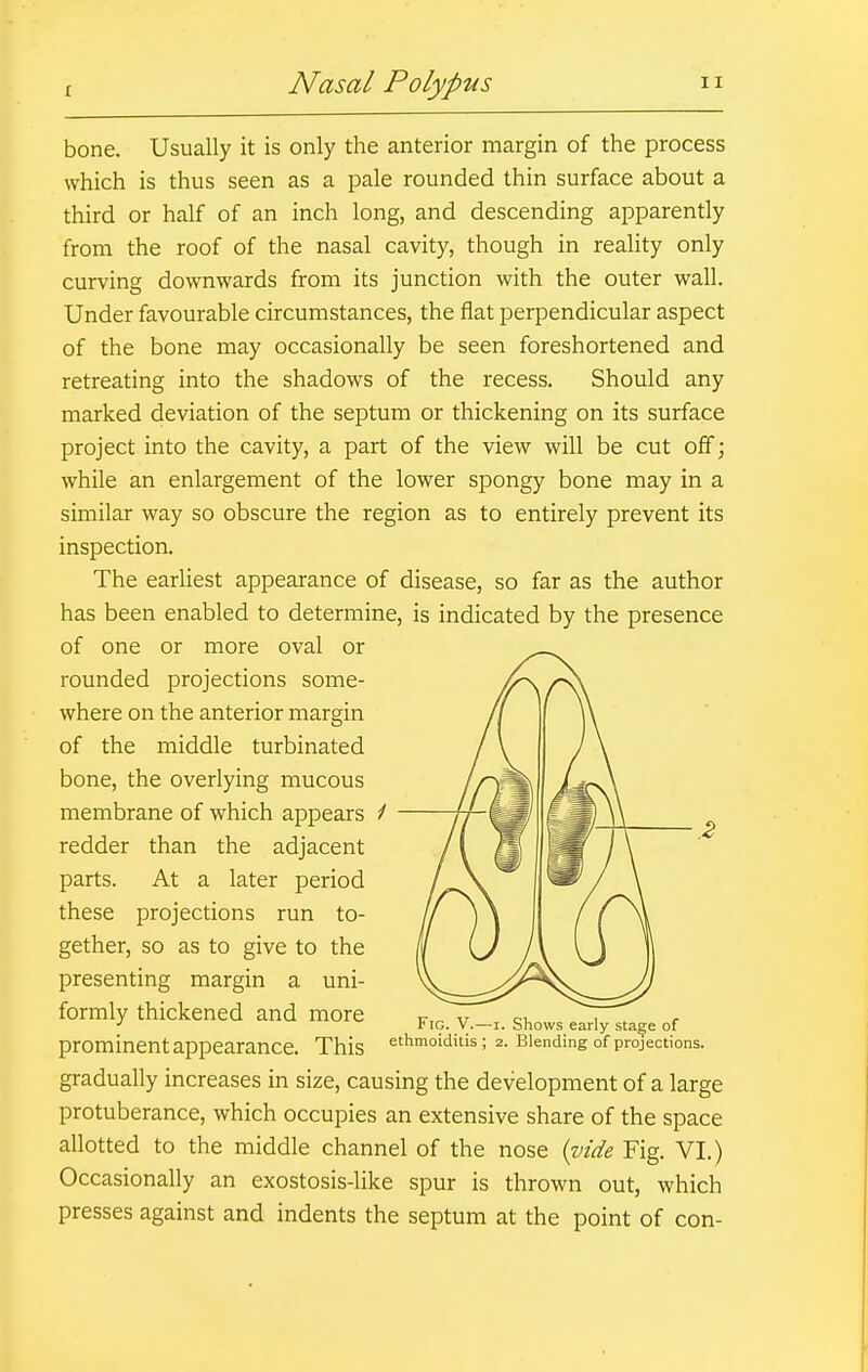 bone. Usually it is only the anterior margin of the process which is thus seen as a pale rounded thin surface about a third or half of an inch long, and descending apparently from the roof of the nasal cavity, though in reality only curving downwards from its junction with the outer wall. Under favourable circumstances, the flat perpendicular aspect of the bone may occasionally be seen foreshortened and retreating into the shadows of the recess. Should any marked deviation of the septum or thickening on its surface project into the cavity, a part of the view will be cut off; while an enlargement of the lower spongy bone may in a similar way so obscure the region as to entirely prevent its inspection. The earliest appearance of disease, so far as the author has been enabled to determine, is indicated by the presence of one or more oval or rounded projections some- where on the anterior margin of the middle turbinated bone, the overlying mucous membrane of which appears redder than the adjacent parts. At a later period these projections run to- gether, so as to give to the presenting margin a uni- formly thickened and more prominent appearance. This Fig. V.- ethmoiditis -I. Shows early stage of 2. Blending of projections. gradually increases in size, causing the development of a large protuberance, which occupies an extensive share of the space allotted to the middle channel of the nose (vide Fig. VI.) Occasionally an exostosis-like spur is thrown out, which presses against and indents the septum at the point of con-