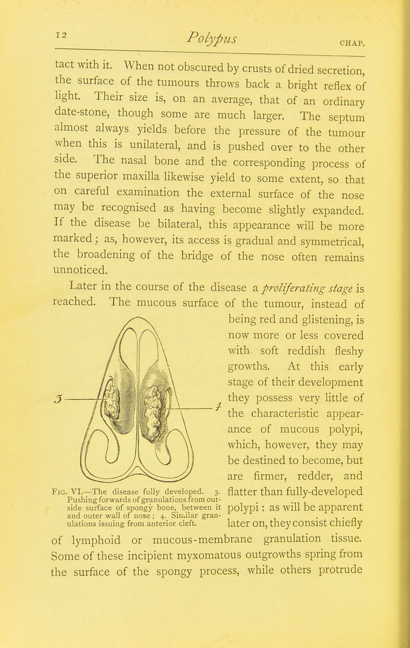 CHAP. tact with it. When not obscured by crusts of dried secretion, the surface of the tumours throws back a bright reflex of hght. Their size is, on an average, that of an ordinary date-stone, though some are much larger. The septum almost always yields before the pressure of the tumour when this is unilateral, and is pushed over to the other side. The nasal bone and the corresponding process of the superior maxilla likewise yield to some extent, so that on careful examination the external surface of the nose may be recognised as having become slightly expanded. If the disease be bilateral, this appearance will be more marked; as, however, its access is gradual and symmetrical, the broadening of the bridge of the nose often remains unnoticed. Later in the course of the disease a proliferating stage is reached. The mucous surface of the tumour, instead of being red and glistening, is now more or less covered with soft reddish fleshy growths. At this early stage of their development they possess very little of the characteristic appear- ance of mucous polypi, which, however, they may be destined to become, but are firmer, redder, and Fig. VI.—The disease fully developed. 3- flatter than fully-dcveloped Pushing forwards of granulations from out- side surface of spongy bone,_ between it polypi : aS Will be apparent and outer wall of nose; 4. Sinalar gran- • ^ • a ulations issuing from anterior cleft. later OU, they COUSlSt ChlCfly of lymphoid or mucous-membrane granulation tissue. Some of these incipient myxomatous outgrowths spring from the surface of the spongy process, while others protrude