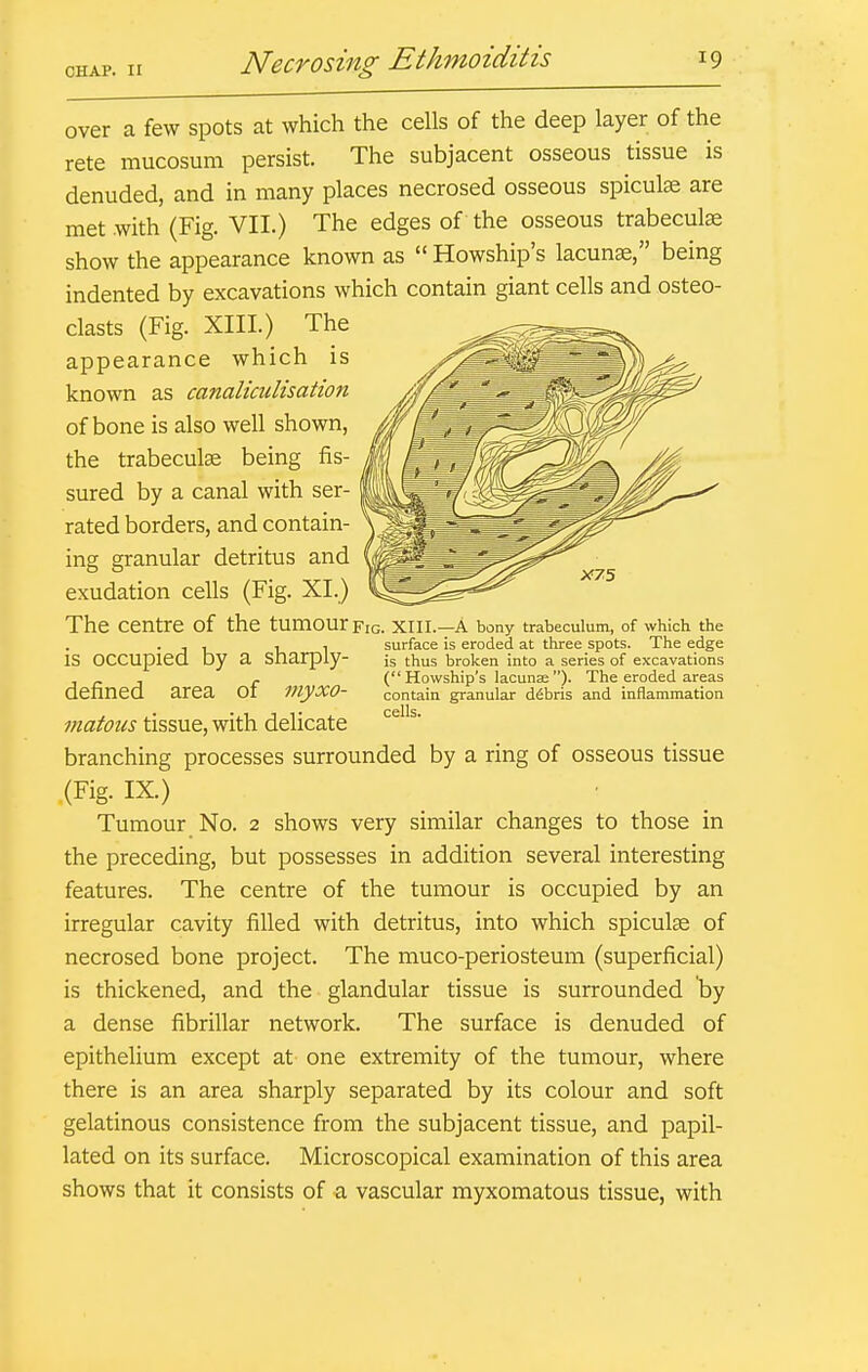 CHAP. II over a few spots at which the cells of the deep layer of the rete mucosum persist. The subjacent osseous tissue is denuded, and in many places necrosed osseous spicule are met with (Fig. VII.) The edges of the osseous trabeculae show the appearance known as  Howship's lacunae, being indented by excavations which contain giant cells and osteo- clasts (Fig. XIII.) The appearance which is known as canaliculisation of bone is also well shown, the trabeculse being fis- sured by a canal with ser- rated borders, and contain- ing granular detritus and exudation cells (Fig. XL) The centre of the tumour Fig. XIII.—a bony trabeculum, of which the . ^ , r 1 surface is eroded at three spots. The edge is occupied by a sharply- is thus broken into a series of excavations , _ . r ( Howship's lacunae )• The eroded areas denned area or myXO- contain granular debris and inflammation matous tissue, with delicate '^^ ^' branching processes surrounded by a ring of osseous tissue (Fig. IX) Tumour No. 2 shows very similar changes to those in the preceding, but possesses in addition several interesting features. The centre of the tumour is occupied by an irregular cavity filled with detritus, into which spiculse of necrosed bone project. The muco-periosteum (superficial) is thickened, and the glandular tissue is surrounded by a dense fibrillar network. The surface is denuded of epithelium except at one extremity of the tumour, where there is an area sharply separated by its colour and soft gelatinous consistence from the subjacent tissue, and papil- lated on its surface. Microscopical examination of this area shows that it consists of a vascular myxomatous tissue, with