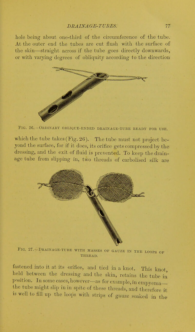 hole being about one-third of the circumference of the tube. At the outer end the tubes are cut flush with the surface of the skin—straight across if the tube goes directly downwards, or with varying degrees of obliquity according to the direction Fig. 26. - Ordinary oblique-ended drainage-tube ready for use. which the tube takes (Fig. 26). The tube must not project be- yond the surface, for if it does, its orifice gets compressed by the dressing, and the exit of fluid is prevented. To keep the drain- age tube from shpping in, two threads of carbolised silk are Fig. 27.-Drainage-tube with masses of gauze in the loops of THREAD. fastened into it at its orifice, and tied in a knot. This knot held between the dressing and the skin, retains the tube in position. In some cases,however—as for examjjle, in emijyema the tube might slip in in spite of these threads, and therefore it is well to fill up the loops with strips of gauze soaked in the