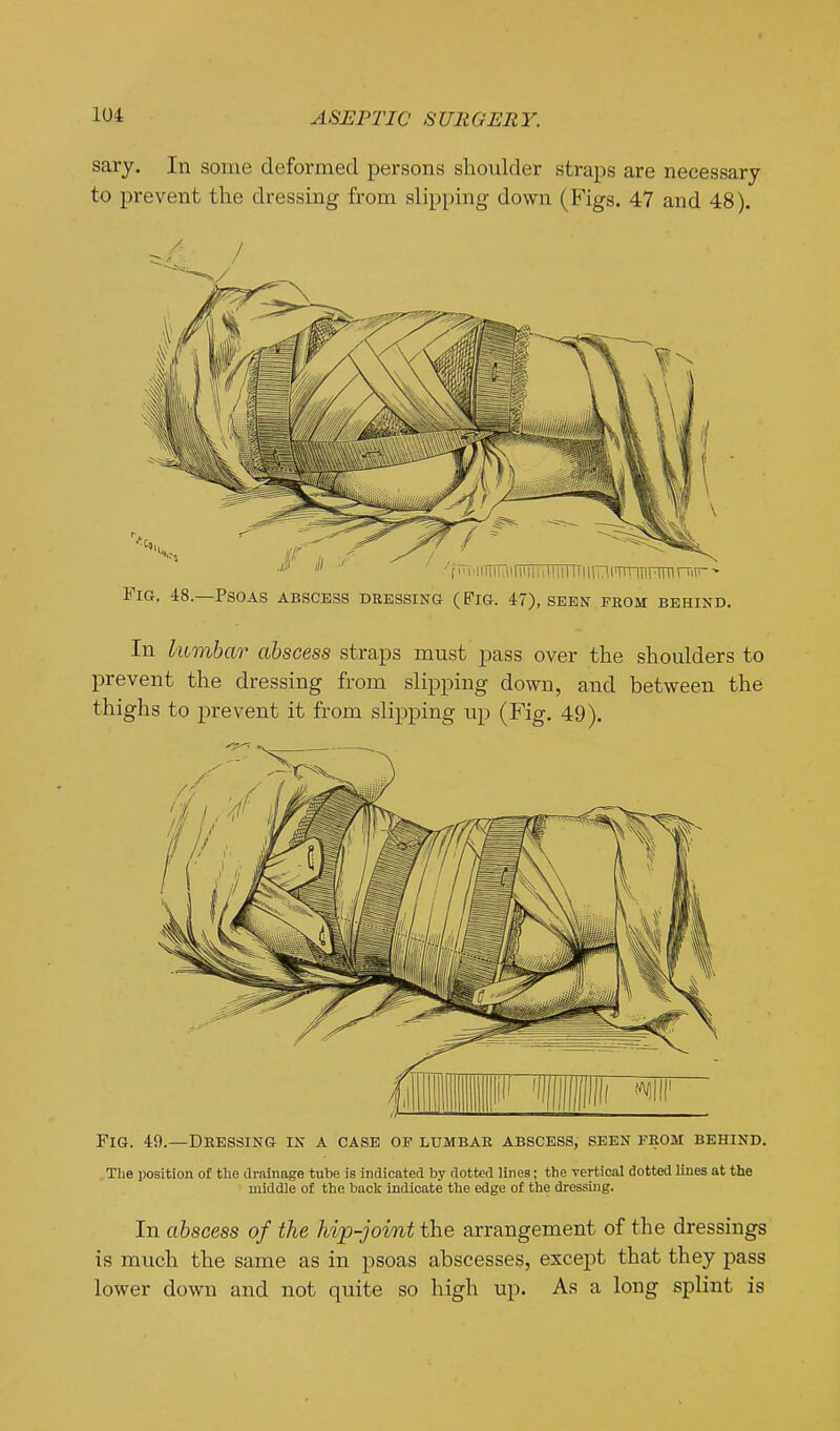 sary. In some deformed persons shoulder straps are necessary to prevent the dressing from slipping down (Figs. 47 and 48). Fig. 48.—Psoas abscess dressing (Fig. 47), seen feom behind. In lumbar abscess straps must pass over the shoulders to prevent the dressing from slipping down, and between the thighs to prevent it from slipping up (Fig. 49). Fig. 49.—Dhessing in a case of lumbae abscess, seen feom behind. .The position of the drainage tube is indicated by dotted lines; the vertical dotted lines at the middle of the back indicate the edge of the dressing. In abscess of the hip-joint the arrangement of the dressings is much the same as in psoas abscesses, except that they pass lower down and not quite so high up. As a long splint is