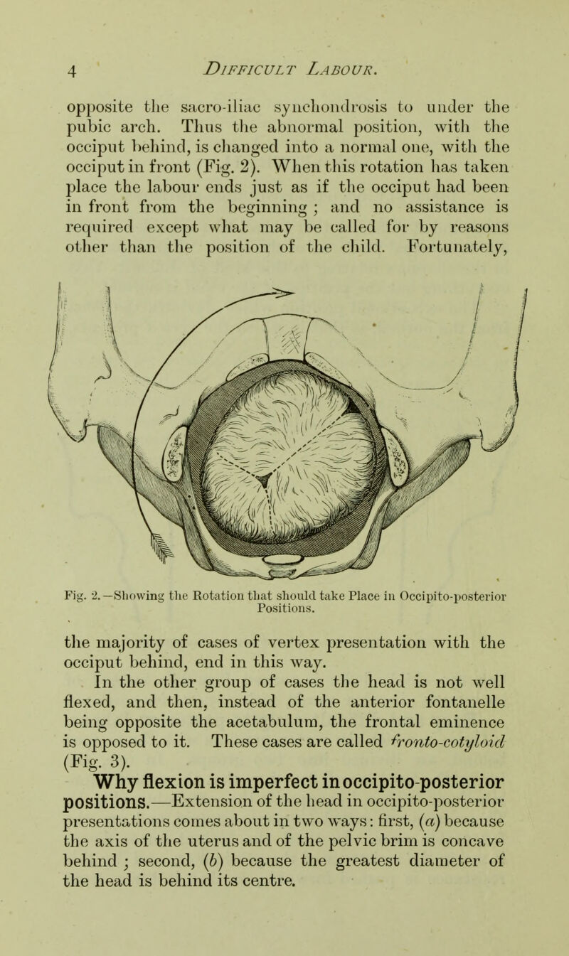 opposite the sacro iliac synchondrosis to under the pubic arch. Thus the abnormal position, with the occiput behind, is changed into a normal one, with the occiput in front (Fig. 2). When this rotation has taken place the labour ends just as if the occiput had been in front from the beginning ; and no assistance is required except what may be called for by reasons other than the position of the child. Fortunately, Fig. 2.—Showing the Rotation that should take Place in Occipito-posterior Positions. the majority of cases of vertex presentation with the occiput behind, end in this way. In the other group of cases the head is not well flexed, and then, instead of the anterior fontanelle being opposite the acetabulum, the frontal eminence is opposed to it. These cases are called fronto-cotyloid (Fig. 3). Why flexion is imperfect in occipito-posterior positions.—Extension of the head in occipito-posterior presentations comes about in two ways: first, (a) because the axis of the uterus and of the pelvic brim is concave behind ; second, (b) because the greatest diameter of the head is behind its centre.