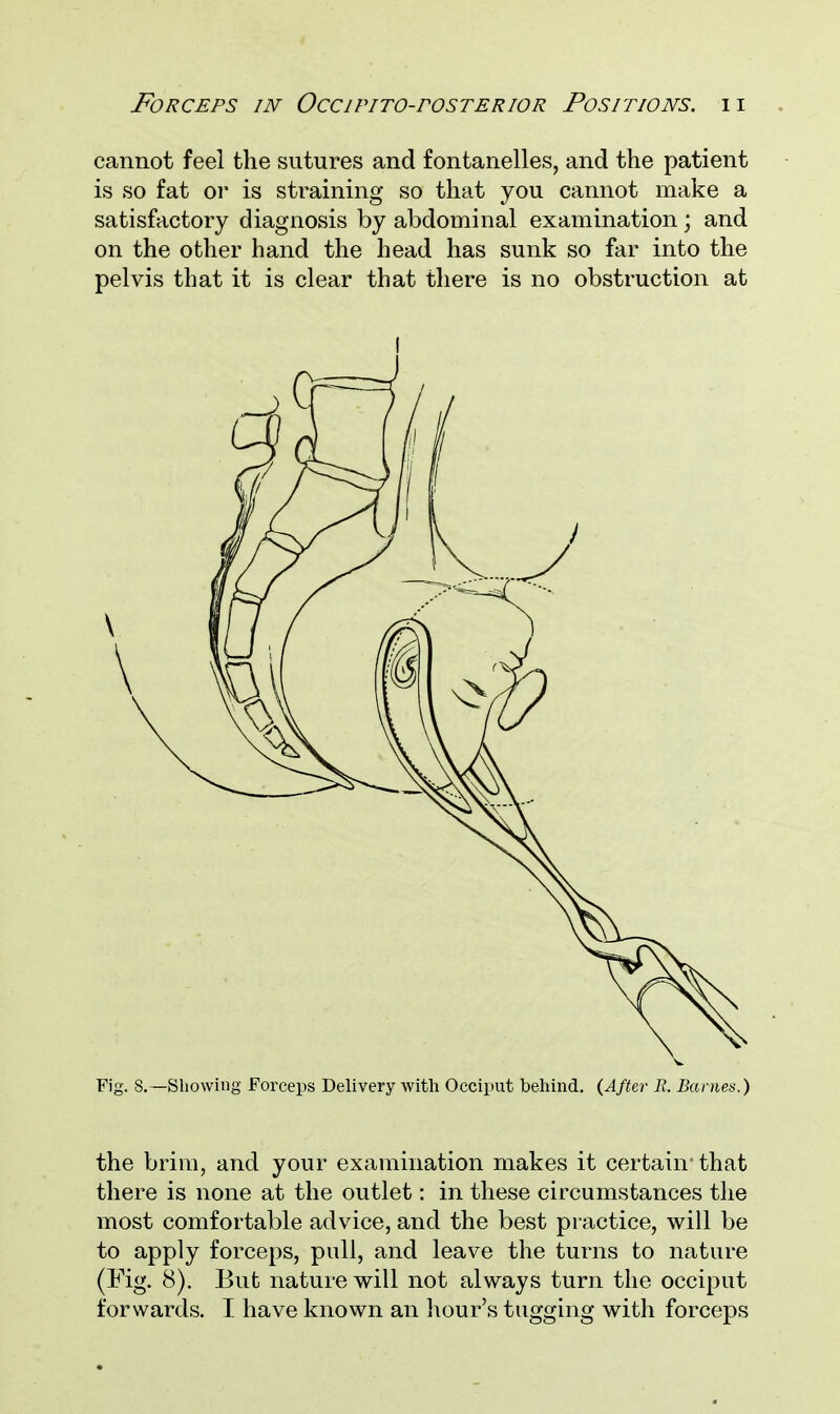 cannot feel the sutures and fontanelles, and the patient is so fat or is straining so that you cannot make a satisfactory diagnosis by abdominal examination ; and on the other hand the head has sunk so far into the pelvis that it is clear that there is no obstruction at ! Fig. S.—Showing Forceps Delivery with Occiput behind. (After R. Barnes.) the brim, and your examination makes it certain' that there is none at the outlet: in these circumstances the most comfortable advice, and the best practice, will be to apply forceps, pull, and leave the turns to nature (Fig. 8). But nature will not always turn the occiput forwards. I have known an hour's tugging with forceps