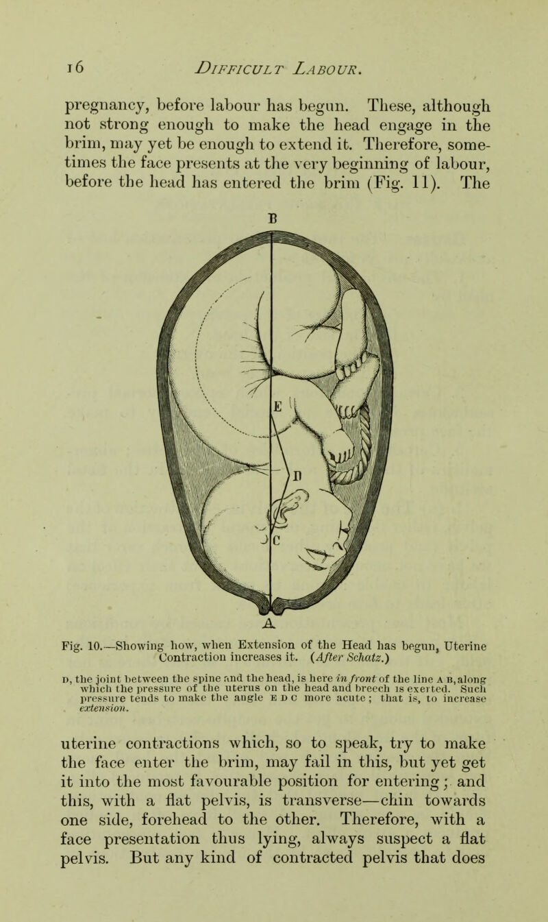 pregnancy, before labour has begun. These, although not strong enough to make the head engage in the brim, may yet be enough to extend it. Therefore, some- times the face presents at the very beginning of labour, before the head has entered the brim (Fig. 11). The B A Fig. 10.—Showing how, when Extension of the Head has begun, Uterine Contraction increases it. (After Schatz.) d, the joint between the spine .Mid the head, is here in front of the line a B.along which the pressure of the uterus on the head and breech is exerted. Such pressure tends to make the augle edc more acute; that is, to increase extension. uterine contractions which, so to speak, try to make the face enter the brim, may fail in this, but yet get it into the most favourable position for entering; and this, with a flat pelvis, is transverse—chin towards one side, forehead to the other. Therefore, with a face presentation thus lying, always suspect a flat pelvis. But any kind of contracted pelvis that does