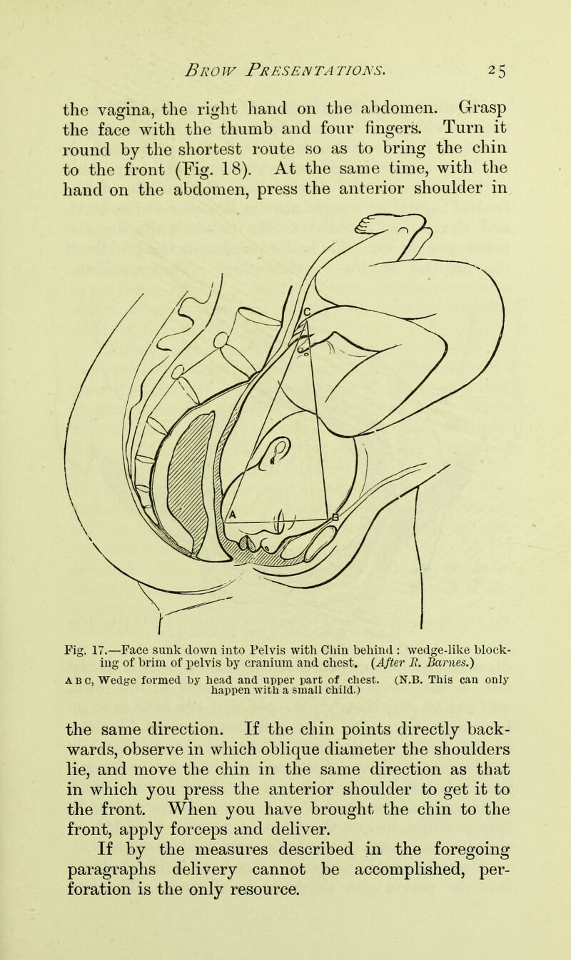 Brow Presentations. the vagina, the right hand on the abdomen. Grasp the face with the thumb and four fingers. Turn it round by the shortest route so as to bring the chin to the front (Fig. 18). At the same time, with the hand on the abdomen, press the anterior shoulder in Fig. 17.—Face sunk down into Pelvis with Chin behind : wedge-like block- ing of brim of pelvis by cranium and chest. (After i?. Barnes.) abc, Wedge formed hy head and upper part of chest. (N.B. This can only happen with a small child.) the same direction. If the chin points directly back- wards, observe in which oblique diameter the shoulders lie, and move the chin in the same direction as that in which you press the anterior shoulder to get it to the front. When you have brought the chin to the front, apply forceps and deliver. If by the measures described in the foregoing paragraphs delivery cannot be accomplished, per- foration is the only resource.