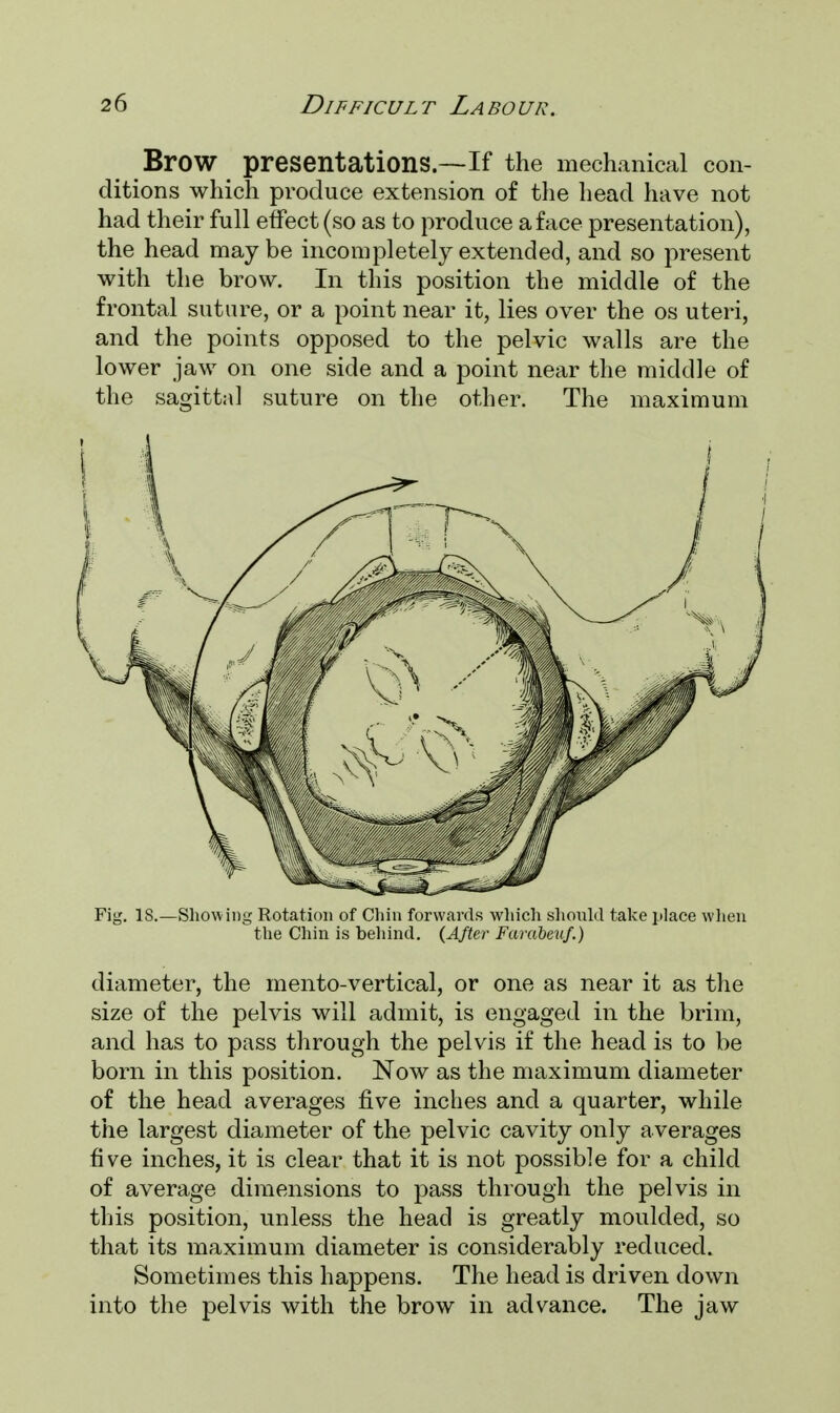 BrOW presentations.—If the mechanical con- ditions which produce extension of the head have not had their full effect (so as to produce a face presentation), the head may be incompletely extended, and so present with the brow. In this position the middle of the frontal suture, or a point near it, lies over the os uteri, and the points opposed to the pelvic walls are the lower jaw on one side and a point near the middle of the sagittal suture on the other. The maximum Fig. IS.—Showing Rotation of Chin forwards which should take place when the Chin is behind. (After Farabeuf.) diameter, the mento-vertical, or one as near it as the size of the pelvis will admit, is engaged in the brim, and has to pass through the pelvis if the head is to be born in this position. Now as the maximum diameter of the head averages five inches and a quarter, while the largest diameter of the pelvic cavity only averages five inches, it is clear that it is not possible for a child of average dimensions to pass through the pelvis in this position, unless the head is greatly moulded, so that its maximum diameter is considerably reduced. Sometimes this happens. The head is driven down into the pelvis with the brow in advance. The jaw