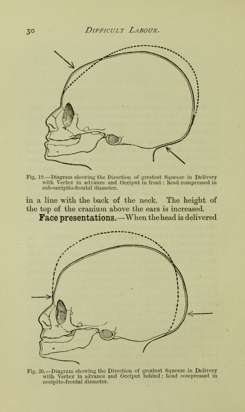 3° Fig. 19.—Diagram showing the Direction of greatest Squeeze in Delivery with Vertex in advance and Occiput in front: head compressed in sub-occipito-frontal diameter. in a line with the back of the neck. The height of the top of the cranium above the ears is increased. Face presentations.—When the head is delivered Fig. 20.—Diagram showing the Direction of greatest Squeeze in Delivery with Vertex in advance and Occiput behind: head compressed in occipito-frontal diameter.