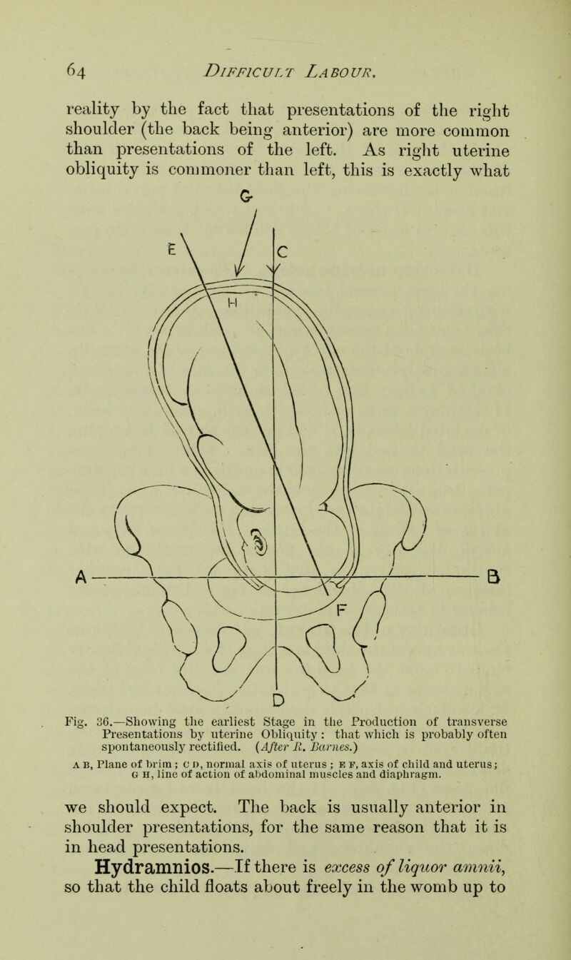 reality by the fact that presentations of the right shoulder (the back being anterior) are more common than presentations of the left. As right uterine obliquity is commoner than left, this is exactly what Fig. 36.—Showing the earliest Stage in the Production of transverse Presentations by uterine Obliquity : that which is probably often spontaneously rectified. (After li. Barnes.) A B, Plane of brim ; c D, normal axis of uterus ; e f, axis of child and uterus; G H, line of action of abdominal muscles and diaphragm. we should expect. The back is usually anterior in shoulder presentations, for the same reason that it is in head presentations. Hydramnios.—If there is excess of liquor amnii, so that the child floats about freely in the womb up to