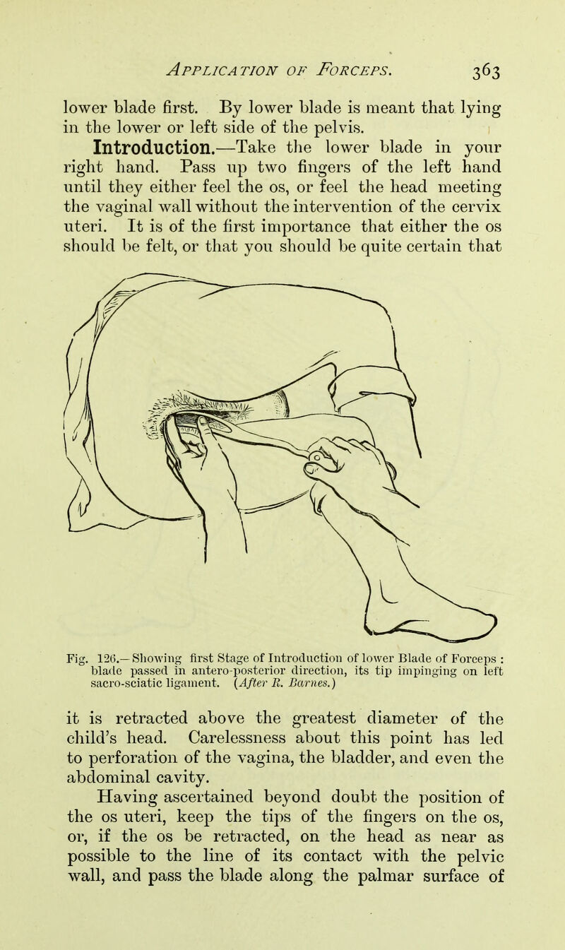 lower blade first. By lower blade is meant that lying in the lower or left side of the pelvis. Introduction.—Take the lower blade in your right hand. Pass up two fingers of the left hand until they either feel the os, or feel the head meeting the vaginal wall without the intervention of the cervix uteri. It is of the first importance that either the os should be felt, or that you should be quite certain that Fig. 126.—Showing first Stage of Introduction of lower Blade of Forceps : blade passed in antero-posterior direction, its tip impinging on left sacro-sciatic ligament. (After R. Barnes.) it is retracted above the greatest diameter of the child's head. Carelessness about this point has led to perforation of the vagina, the bladder, and even the abdominal cavity. Having ascertained beyond doubt the position of the os uteri, keep the tips of the fingers on the os, or, if the os be retracted, on the head as near as possible to the line of its contact with the pelvic wall, and pass the blade along the palmar surface of