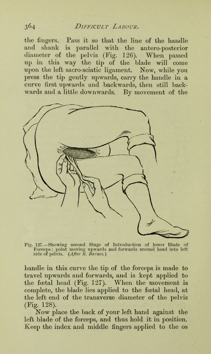 the fingers. Pass it so that the line of the handle and shank is parallel with the antero-posterior diameter of the pelvis (Fig. 126). When passed up in this way the tip of the blade will come upon the left sacro-sciatic ligament. Now, while you press the tip gently upwards, carry the handle in a curve first upwards and backwards, then still back- wards and a little downwards. By movement of the Fig. 127.—Showing second Stage of Introduction of lower Blade of Forceps: point moving upwards and forwards around head into left side of pelvis. (After R. Barnes.) handle in this curve the tip of the forceps is made to travel upwards and forwards, and is kept applied to the foetal head (Fig. 127). When the movement is complete, the blade lies applied to the foetal head, at the left end of the transverse diameter of the pelvis (Fig. 128). Now place the back of your left hand against the left blade of the forceps, and thus hold it in position. Keep the index and middle fingers applied to the os