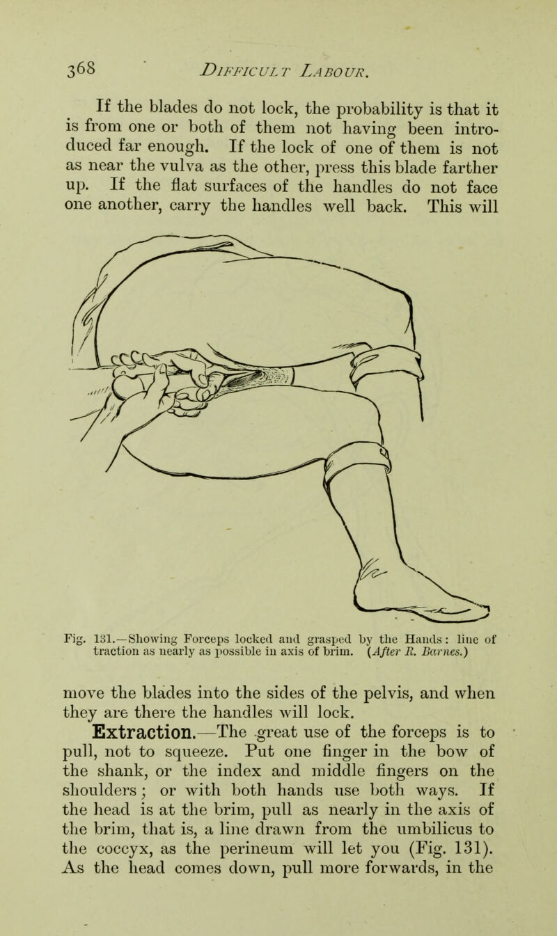 If the blades do not lock, the probability is that it is from one or both of them not having been intro- duced far enough. If the lock of one of them is not as near the vulva as the other, press this blade farther up. If the flat surfaces of the handles do not face one another, carry the handles well back. This will Fig. 131.—Showing Forceps locked and grasped by the Hands: line of traction as nearly as possible in axis of brim. (After R. Barnes.) move the blades into the sides of the pelvis, and when they are there the handles will lock. Extraction.—The .great use of the forceps is to pull, not to squeeze. Put one finger in the bow of the shank, or the index and middle fingers on the shoulders ; or with both hands use both ways. If the head is at the brim, pull as nearly in the axis of the brim, that is, a line drawn from the umbilicus to the coccyx, as the perineum will let you (Fig. 131). As the head comes down, pull more forwards, in the