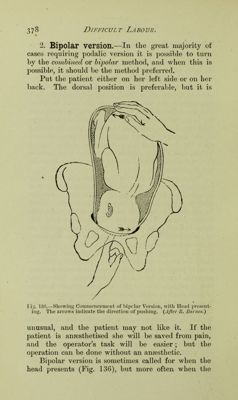 2. Bipolar version.—In the great majority of cases requiring podalic version it is possible to turn by the combined or bipolar method, and when this is possible, it should be the method preferred. Put the patient either on her left side or on her back. The dorsal position is preferable, but it is I ig. 136.—Showing Commencement of bipolar Version, with Head present- ing. The arrows indicate the direction of pushing. (After B. Barnes.) unusual, and the patient may not like it. If the patient is anaesthetised she will be saved from pain, and the operator's task will be easier ; but the operation can be done without an anaesthetic. Bipolar version is sometimes called for when the head presents (Fig. 136), but more often when the