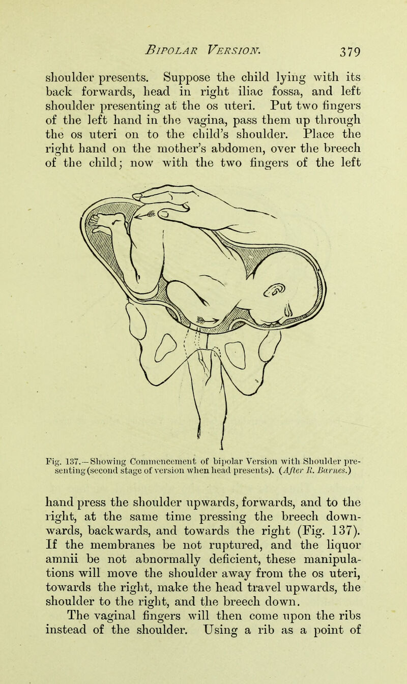 shoulder presents. Suppose the child lying with its back forwards, head in right iliac fossa, and left shoulder presenting at the os uteri. Put two fingers of the left hand in the vagina, pass them up through the os uteri on to the child's shoulder. Place the right hand on the mother's abdomen, over the breech of the child; now with the two fingers of the left Fig. 137.—Showing Commencement of bipolar Version witli Shoulder pre- senting (second stage of version when head presents). (After B. Barnes.) hand press the shoulder upwards, forwards, and to the light, at the same time pressing the breech down- wards, backwards, and towards the right (Fig. 137). If the membranes be not ruptured, and the liquor amnii be not abnormally deficient, these manipula- tions will move the shoulder away from the os uteri, towards the right, make the head travel upwards, the shoulder to the right, and the breech down. The vaginal fingers will then come upon the ribs instead of the shoulder. Using a rib as a point of