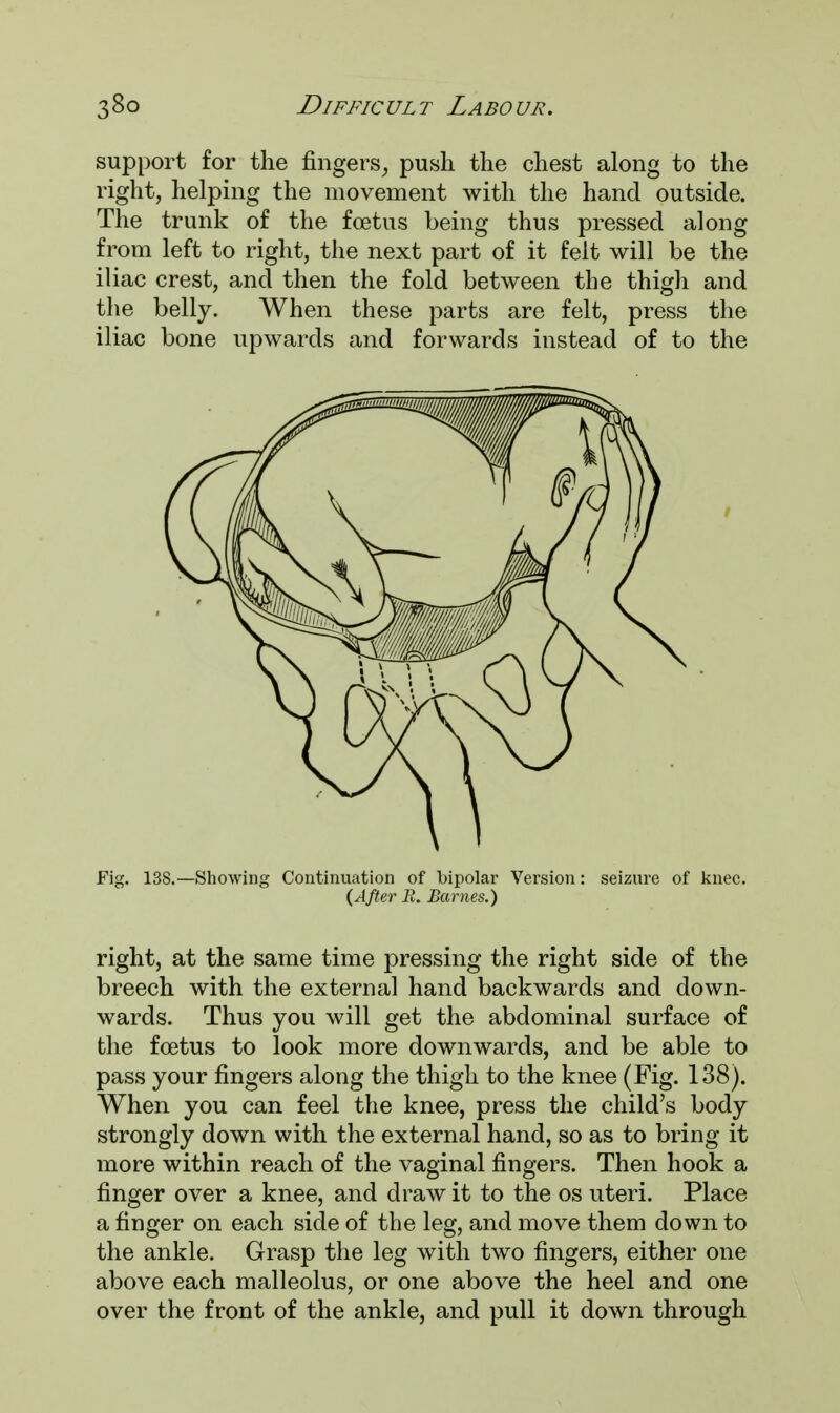 support for the fingers, push the chest along to the right, helping the movement with the hand outside. The trunk of the foetus being thus pressed along from left to right, the next part of it felt will be the iliac crest, and then the fold between the thigh and the belly. When these parts are felt, press the iliac bone upwards and forwards instead of to the Fig. 138.—Showing Continuation of bipolar Version: seizure of knee. (After R. Barnes.) right, at the same time pressing the right side of the breech with the external hand backwards and down- wards. Thus you will get the abdominal surface of the foetus to look more downwards, and be able to pass your fingers along the thigh to the knee (Fig. 138). When you can feel the knee, press the child's body strongly down with the external hand, so as to bring it more within reach of the vaginal fingers. Then hook a finger over a knee, and draw it to the os uteri. Place a finger on each side of the leg, and move them down to the ankle. Grasp the leg with two fingers, either one above each malleolus, or one above the heel and one over the front of the ankle, and pull it down through