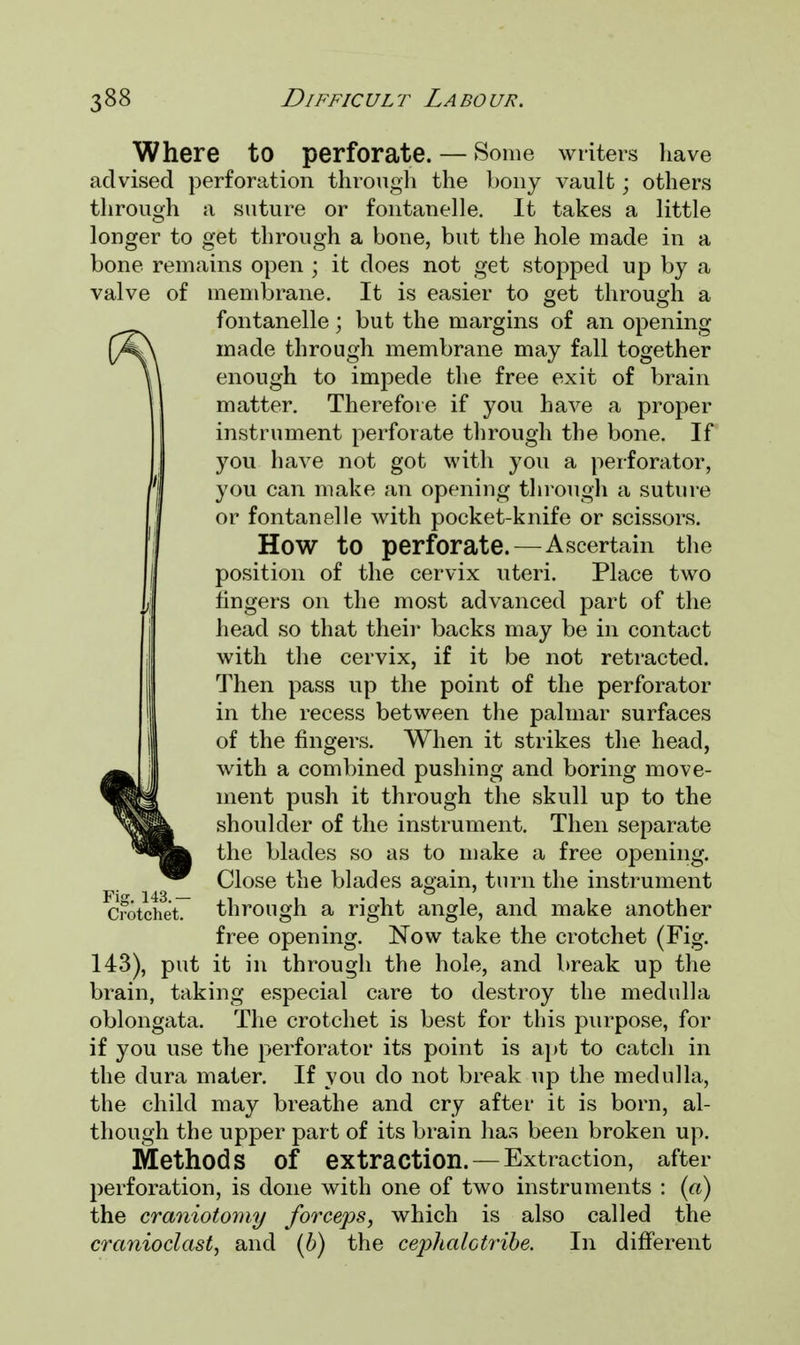 Where to perforate. — Some writers have advised perforation through the bony vault ■ others through a suture or fontanelle. It takes a little longer to get through a bone, but the hole made in a bone remains open ; it does not get stopped up by a valve of membrane. It is easier to get through a fontanelle; but the margins of an opening (/\\ made through membrane may fall together U enough to impede the free exit of brain matter. Therefore if you have a proper instrument perforate through the bone. If you have not got with you a perforator, you can make an opening through a suture or fontanelle with pocket-knife or scissors. HOW to perforate. — Ascertain the position of the cervix uteri. Place two fingers on the most advanced part of the head so that their backs may be in contact with the cervix, if it be not retracted. Then pass up the point of the perforator in the recess between the palmar surfaces of the fingers. When it strikes the head, with a combined pushing and boring move- ment push it through the skull up to the shoulder of the instrument. Then separate the blades so as to make a free opening. Close the blades again, turn the instrument CrotchetT through a right angle, and make another free opening. Now take the crotchet (Fig. 143), put it in through the hole, and break up the brain, taking especial care to destroy the medulla oblongata. The crotchet is best for this purpose, for if you use the perforator its point is apt to catch in the dura mater. If you do not break up the medulla, the child may breathe and cry after it is born, al- though the upper part of its brain has been broken up. Methods Of extraction. —Extraction, after perforation, is done with one of two instruments : (a) the craniotomy forceps, which is also called the cranioclast, and (b) the cephalGtribe. In different