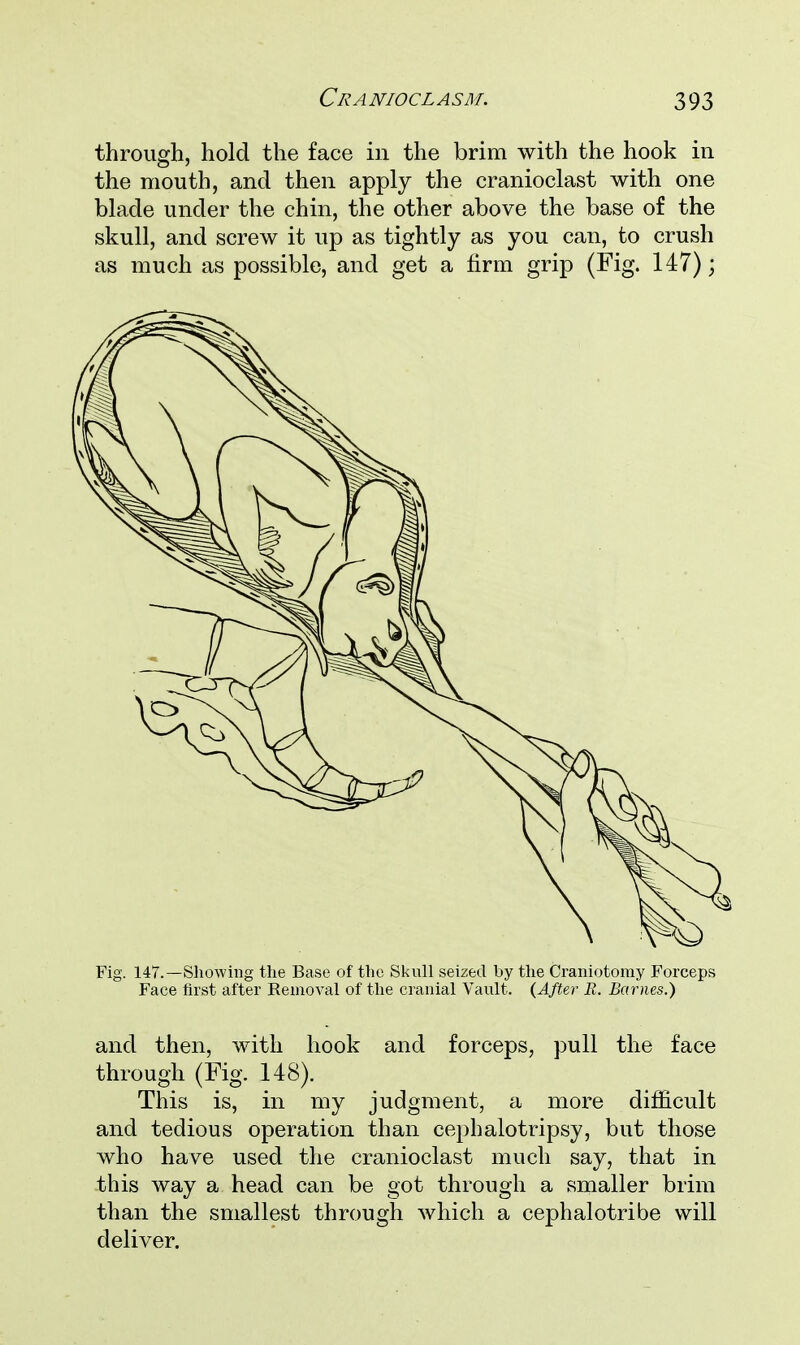 through, hold the face in the brim with the hook in the mouth, and then apply the cranioclast with one blade under the chin, the other above the base of the skull, and screw it up as tightly as you can, to crush as much as possible, and get a firm grip (Fig. 147); Fig. 147.—Showing the Base of the Skull seized by the Craniotomy Forceps Face first after Removal of the cranial Vault. (After B. Barnes.) and then, with hook and forceps, pull the face through (Fig. 148). This is, in my judgment, a more difficult and tedious operation than cephalotripsy, but those who have used the cranioclast much say, that in this way a head can be got through a smaller brim than the smallest through which a cephalotribe will deliver.