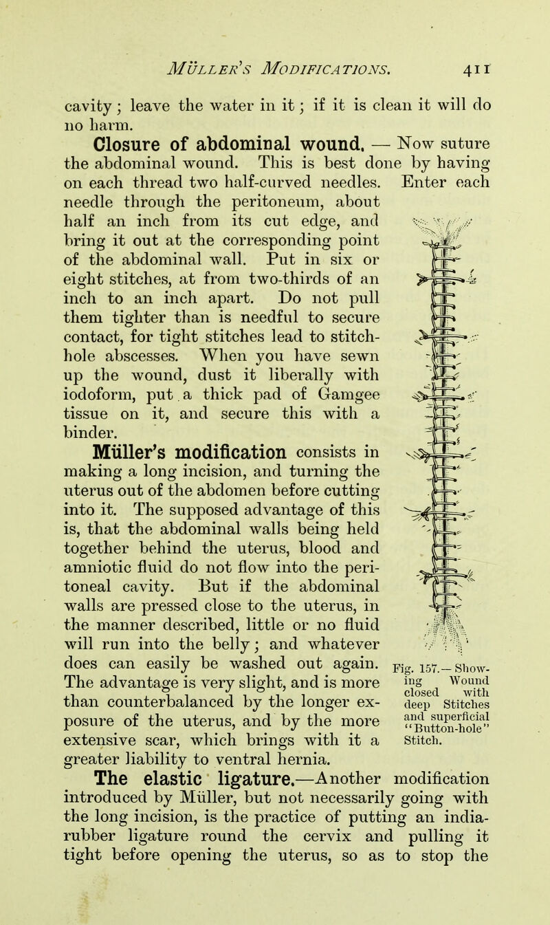 Muller's Modifica T10NS. cavity; leave the water in it; if it is clean it will do no barm. Closure of abdominal wound. — Now suture the abdominal wound. This is best done by having on each thread two half-curved needles. Enter each needle through the peritoneum, about half an inch from its cut edge, and ^W*?*' bring it out at the corresponding point of the abdominal wall. Put in six or eight stitches, at from two-thirds of an inch to an inch apart. Do not pull them tighter than is needful to secure contact, for tight stitches lead to stitch- hole abscesses. When you have sewn up the wound, dust it liberally with iodoform, put a thick pad of Gamgee tissue on it, and secure this with a binder. Muller's modification consists in making a long incision, and turning the uterus out of the abdomen before cutting into it. The supposed advantage of this is, that the abdominal walls being held together behind the uterus, blood and amniotic fluid do not flow into the peri- toneal cavity. But if the abdominal walls are pressed close to the uterus, in the manner described, little or no fluid will run into the belly; and whatever does can easily be washed out again. The advantage is very slight, and is more than counterbalanced by the longer ex- posure of the uterus, and by the more extensive scar, which brings with it a greater liability to ventral hernia. The elastic ligature.—Another modification introduced by Muller, but not necessarily going with the long incision, is the practice of putting an india- rubber ligature round the cervix and pulling it- tight before opening the uterus, so as to stop the Fig. 157.— Show- ing Wound closed with deep Stitches and superficial Button-hole Stitch.