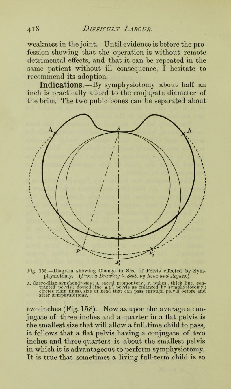 weakness in the joint. Until evidence is before the pro- fession showing that the operation is without remote detrimental effects, and that it can be repeated in the same patient without ill consequence, I hesitate to recommend its adoption. Indications.—By symphysiotomy about half an inch is practically added to the conjugate diameter of the brim. The two pubic bones can be separated about Fig. 158.—Diagram allowing Change in Size of Pelvis effected by Sym- physiotomy. (From a Drawing to Scale by Roux and Eeynes.) a, Sacro-iliac synchondroses; s, sacral promontory; p, pubes; thick line, con- tracted pelvis; dotted line A r', pelvis as enlarged by symphysiotomy; circles (thin lines), size of head that can pass through pelvis before and after symphysiotomy. two inches (Fig. 158). Now as upon the average a con- jugate of three inches and a quarter in a flat pelvis is the smallest size that will allow a full-time child to pass, it follows that a flat pelvis having a conjugate of two inches and three-quarters is about the smallest pelvis in which it is advantageous to perform symphysiotomy. It is true that sometimes a living full-term child is so