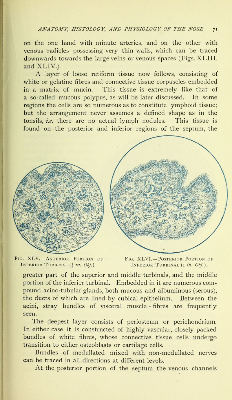 on the one hand with minute arteries, and on the other with venous radicles possessing very thin walls, which can be traced downwards towards the large veins or venous spaces (Figs. XLIII. and XLIV.). A layer of loose retiform tissue now follows, consisting of white or gelatine fibres and connective tissue corpuscles embedded in a matrix of mucin. This tissue is extremely like that of a so-called mucous polypus, as will be later discussed. In some regions the cells are so numerous as to constitute lymphoid tissue; but the arrangement never assumes a defined shape as in the tonsils, i.e. there are no actual lymph nodules. This tissue is found on the posterior and inferior regions of the septum, the Fig. XLV.—Anterior Portion of Fig. XLVI.—Posterior Portion of Inferior Turbinal {| in. Obj.). Inferior Turbinal (i in. Obj.). greater part of the superior and middle turbinals, and the middle portion of the inferior turbinal. Embedded in it are numerous com- pound acino-tubular glands, both mucous and albuminous (serous), the ducts of which are lined by cubical epithelium. Between the acini, stray bundles of visceral muscle - fibres are frequently seen. The deepest layer consists of periosteum or perichondrium. In either case it is constructed of highly vascular, closely packed bundles of white fibres, whose connective tissue cells undergo transition to either osteoblasts or cartilage cells. Bundles of medullated mixed with non-meduUated nerves can be traced in all directions at different levels. At the posterior portion of the septum the venous channels