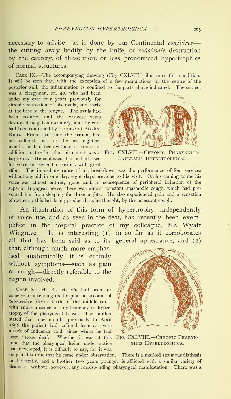 necessary to advise—as is done by our Continental confreres— the cutting away bodily by the knife, or wholesale destruction by the cautery, of these more or less pronounced hypertrophies of normal structures. Case IX.—The accompanying drawing (Fig. CXLVII.) illustrates this condition. It will be seen that, with the exception of a few granulations in the centre of the posterior wall, the inflammation is confined to the parts above indicated. The subject was a clergyman, set. 40, who had been under my care four years previously for chronic relaxation of his uvula, and varix at the base of the tongue. The uvula had been reduced and the varicose veins destroyed by galvano-cautery, and the cure had been confirmed by a course at Aix-les- Bains. From that time the patient had not suffered, but for the last eighteen months he had been without a curate, in addition to the fact that his church was a FiG. CXLVII.—Chronic Pharyngitis large one. He confessed that he had used Lateralis Hypertrophica. his voice on several occasions with great effort. The immediate cause of his breakdown was the performance of four services without any aid in one day, eight days previous to his visit. On his coming to me his voice was almost entirely gone, and, in consequence of peripheral irritation of the superior laryngeal nerve, there was almost constant spasmodic cough, which had pre- vented him from sleeping for three nights. He also experienced pain and a sensation of rawness ; this last being produced, as he thought, by the incessant cough. An illustration of this form of hypertrophy, independently of voice use, and as seen in the deaf, has recently been exem- plified in the hospital practice of my colleague, Mr. Wyatt Wingrave. It is interesting (i) in so far as it corroborates all that has been said as to its general appearance, and (2) that, although much more emphas- ised anatomically, it is entirely without symptoms—such as pain or cough—directly referable to the region involved. Case X.—H. B., tet. 26, had been fpr some years attending the hospital on account of progressive (dry) catarrh of the middle ear— with entire absence of any tendency to hyper- trophy of the pharyngeal tonsil. The mother stated that nine months previously to April j 1898 the patient had suffered from a severe I attack of influenza cold, since which he had been 'stone deaf.' Whether it was at this Fig. CXLVIII.—Chronic Pharyn- time that the pharyngeal lesion under notice gitis Hypertrophica. had developed, it is difficult to say, for it was only at this time that he came under observation. There is a marked strumous diathesis m the family, and a brother two years younger is afflicted with a similar variety of deafness—without, however, any corresponding pharyngeal manifestation. There was a