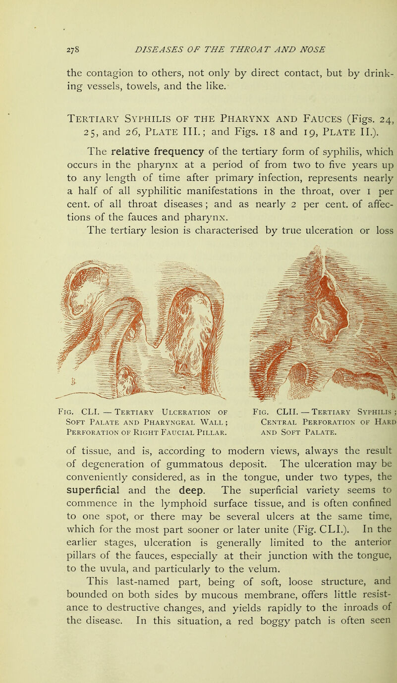 the contagion to others, not only by direct contact, but by drink- ing vessels, towels, and the like. Tertiary Syphilis of the Pharynx and Fauces (Figs. 24, 25, and 26, Plate III.; and Figs. 18 and 19, Plate II.). The relative frequency of the tertiary form of syphilis, which occurs in the pharynx at a period of from two to five years up to any length of time after primary infection, represents nearly a half of all syphilitic manifestations in the throat, over i per cent, of all throat diseases; and as nearly 2 per cent, of affec- tions of the fauces and pharynx. The tertiary lesion is characterised by true ulceration or loss of tissue, and is, according to modern views, always the result of degeneration of gummatous deposit. The ulceration may be conveniently considered, as in the tongue, under two types, the superficial and the deep. The superficial variety seems to commence in the lymphoid surface tissue, and is often confined to one spot, or there may be several ulcers at the same time, which for the most part sooner or later unite (Fig. CLL). In the earlier stages, ulceration is generally limited to the anterior pillars of the fauces, especially at their junction with the tongue, to the uvula, and particularly to the velum. This last-named part, being of soft, loose structure, and bounded on both sides by mucous membrane, offers little resist- ance to destructive changes, and yields rapidly to the inroads of the disease. In this situation, a red boggy patch is often seen Fig. CLL — Tertiary Ulceration of Soft Palate and Pharyngeal Wall ; Perforation of Right Faucial Pillar. Fig. CLII. — Tertiary Syphilis ; Central Perforation of Hard AND Soft Palate.