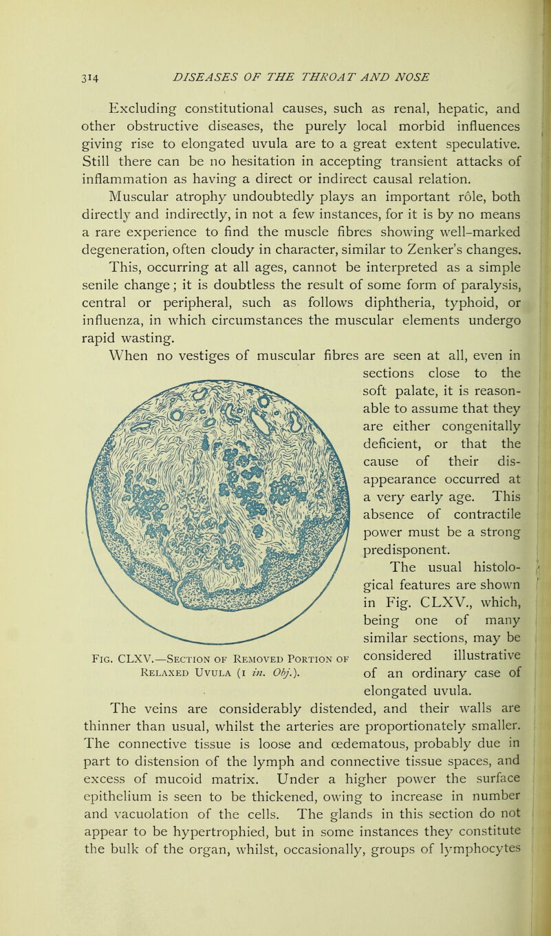 Excluding constitutional causes, such as renal, hepatic, and other obstructive diseases, the purely local morbid influences giving rise to elongated uvula are to a great extent speculative. Still there can be no hesitation in accepting transient attacks of inflammation as having a direct or indirect causal relation. Muscular atrophy undoubtedly plays an important role, both directly and indirectly, in not a few instances, for it is by no means a rare experience to find the muscle fibres showing well-marked degeneration, often cloudy in character, similar to Zenker's changes. This, occurring at all ages, cannot be interpreted as a simple senile change; it is doubtless the result of some form of paralysis, central or peripheral, such as follows diphtheria, typhoid, or influenza, in which circumstances the muscular elements undergo rapid wasting. When no vestiges of muscular fibres are seen at all, even in Fig. CLXV.—Section of Removed Portion of considered illustrative The veins are considerably distended, and their walls are thinner than usual, whilst the arteries are proportionately smaller. The connective tissue is loose and cedematous, probably due in part to distension of the lymph and connective tissue spaces, and excess of mucoid matrix. Under a higher power the surface epithelium is seen to be thickened, owing to increase in number and vacuolation of the cells. The glands in this section do not appear to be hypertrophied, but in some instances they constitute the bulk of the organ, whilst, occasionally, groups of lymphocytes sections close to the soft palate, it is reason- able to assume that they are either congenitally deficient, or that the cause of their dis- appearance occurred at a very early age. This absence of contractile power must be a strong predisponent. The usual histolo- gical features are shown in Fig. CLXV., which, being one of many similar sections, may be Relaxed Uvula (i in. Obj.). of an ordinary case of elongated uvula.