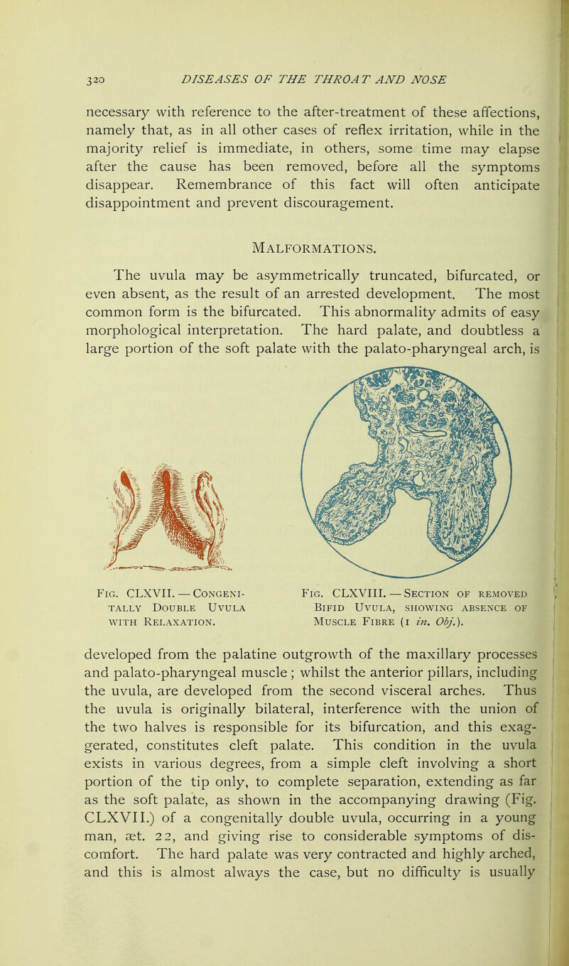 necessary with reference to the after-treatment of these affections, namely that, as in all other cases of reflex irritation, while in the majority relief is immediate, in others, some time may elapse after the cause has been removed, before all the symptoms disappear. Remembrance of this fact will often anticipate disappointment and prevent discouragement. The uvula may be asymmetrically truncated, bifurcated, or even absent, as the result of an arrested development. The most common form is the bifurcated. This abnormality admits of easy morphological interpretation. The hard palate, and doubtless a large portion of the soft palate with the palato-pharyngeal arch, is developed from the palatine outgrowth of the maxillary processes and palato-pharyngeal muscle; whilst the anterior pillars, including the uvula, are developed from the second visceral arches. Thus the uvula is originally bilateral, interference with the union of the two halves is responsible for its bifurcation, and this exag- gerated, constitutes cleft palate. This condition in the uvula exists in various degrees, from a simple cleft involving a short portion of the tip only, to complete separation, extending as far as the soft palate, as shown in the accompanying drawing (Fig. CLXVII.) of a congenitally double uvula, occurring in a young man, aet. 22, and giving rise to considerable symptoms of dis- comfort. The hard palate was very contracted and highly arched, and this is almost always the case, but no difficulty is usually Malformations. Fig. CLXVII. — Congeni- tally Double Uvula WITH Relaxation. Fig. CLXVIII.—Section of removed Bifid Uvula, showing absence of Muscle Fibre (i m. Obj.).