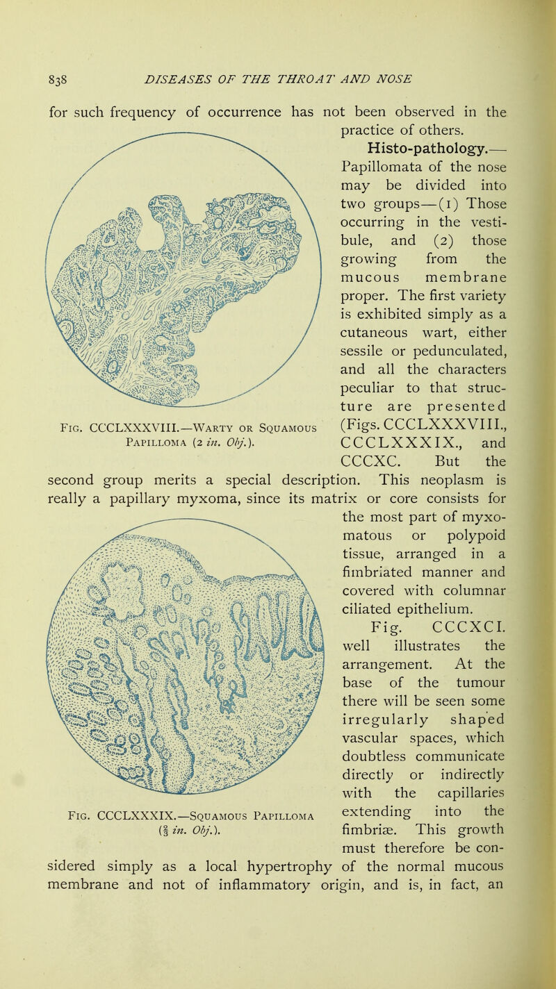 Fig. CCCLXXXVIII.—Warty or Squamous Papilloma {2. in. Obj.). for such frequency of occurrence has not been observed in the practice of others. Histo-pathology.— Papillomata of the nose may be divided into two groups—(i) Those occurring in the vesti- bule, and (2) those growing from the mucous membrane proper. The first variety is exhibited simply as a cutaneous wart, either sessile or pedunculated, and all the characters pecuHar to that struc- ture are presented (Figs. CCCLXXXVIII., CCCLXXXIX., and CCCXC. But the second group merits a special description. This neoplasm is really a papillary myxoma, since its matrix or core consists for the most part of myxo- matous or polypoid tissue, arranged in a fimbriated manner and covered with columnar ciHated epithelium. Fig. CCCXCI. well illustrates the arrangement. At the base of the tumour there will be seen some irregularly shaped vascular spaces, which doubtless communicate directly or indirectly with the capillaries extending into the fimbria. This growth must therefore be con- sidered simply as a local hypertrophy of the normal mucous membrane and not of inflammatory origin, and is, in fact, an Fig. CCCLXXXIX.—Squamous Papilloma (I in. Obj.).