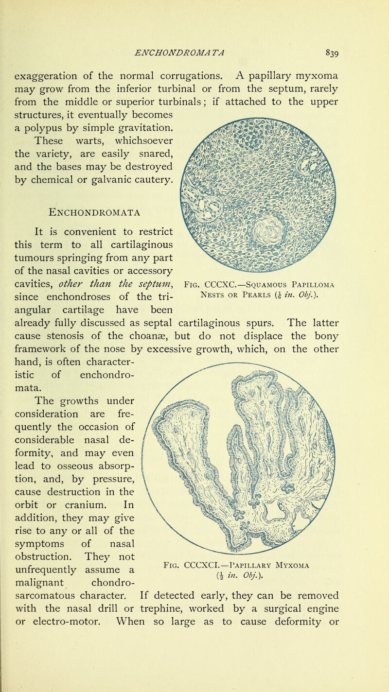 Fig. CCCXC.—Squamous Papilloma Nests or Pearls (J in. Obj.). exaggeration of the normal corrugations. A papillary myxoma may grow from the inferior turbinal or from the septum, rarely from the middle or superior turbinals; if attached to the upper structures, it eventually becomes a polypus by simple gravitation. These warts, whichsoever the variety, are easily snared, and the bases may be destroyed by chemical or galvanic cautery. Enchondromata It is convenient to restrict this term to all cartilaginous tumours springing from any part of the nasal cavities or accessory cavities, other than the septum, since enchondroses of the tri- angular cartilage have been already fully discussed as septal cartilaginous spurs. The latter cause stenosis of the choanae, but do not displace the bony framework of the nose by excessive growth, which, on the other hand, is often character- istic of enchondro- mata. The growths under consideration are fre- quently the occasion of considerable nasal de- formity, and may even lead to osseous absorp- tion, and, by pressure, cause destruction in the orbit or cranium. In addition, they may give rise to any or all of the symptoms of nasal obstruction. They not unfrequently assume a malignant chondro- sarcomatous character. If detected early, they can be removed with the nasal drill or trephine, worked by a surgical engine or electro-motor. When so large as to cause deformity or Fig. CCCXCI.—Papillary Myxoma (1 in. Obj.).