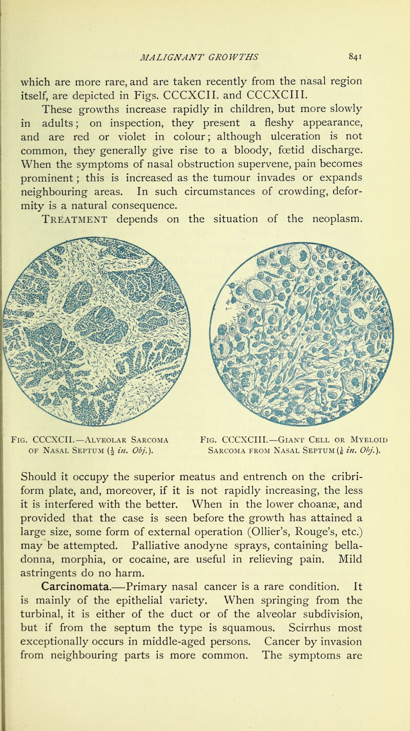 which are more rare, and are taken recently from the nasal region itself, are depicted in Figs. CCCXCII. and CCCXCIII. These growths increase rapidly in children, but more slowly in adults; on inspection, they present a fleshy appearance, and are red or violet in colour; although ulceration is not common, they generally give rise to a bloody, foetid discharge. When the symptoms of nasal obstruction supervene, pain becomes prominent; this is increased as the tumour invades or expands neighbouring areas. In such circumstances of crowding, defor- mity is a natural consequence. Treatment depends on the situation of the neoplasm. Fig. CCCXCII.—Alveolar Sarcoma FiCx. CCCXCIII.—Giant Cell or Myeloid OF Nasal Septum {\ in. Obj.). Sarcoma from Nasal Septum in. ObJ.). Should it occupy the superior meatus and entrench on the cribri- form plate, and, moreover, if it is not rapidly increasing, the less it is interfered with the better. When in the lower choanae, and provided that the case is seen before the growth has attained a large size, some form of external operation (Ollier's, Rouge's, etc.) may be attempted. Palliative anodyne sprays, containing bella- donna, morphia, or cocaine, are useful in relieving pain. Mild astringents do no harm. Carcinomata.—Primary nasal cancer is a rare condition. It is mainly of the epithelial variety. When springing from the turbinal, it is either of the duct or of the alveolar subdivision, but if from the septum the type is squamous. Scirrhus most exceptionally occurs in middle-aged persons. Cancer by invasion from neighbouring parts is more common. The symptoms are