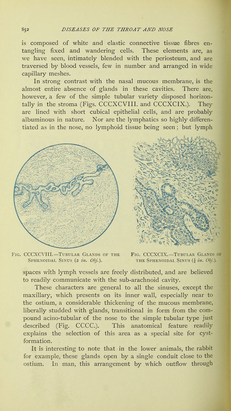 is composed of white and elastic connective tissue fibres en- tangling fixed and wandering cells. These elements are, as we have seen, intimately blended with the periosteum, and are traversed by blood vessels, few in number and arranged in wide capillary meshes. In strong contrast with the nasal mucous membrane, is the almost entire absence of glands in these cavities. There are, however, a few of the simple tubular variety disposed horizon- tally in the stroma (Figs. CCCXCVIII. and CCCXCIX.). They are lined with short cubical epithelial cells, and are probably albuminous in nature. Nor are the lymphatics so highly differen- tiated as in the nose, no lymphoid tissue being seen ; but lymph Fig. CCCXCVIII.—Tubular Glands of the Fig. CCCXCIX.—Tubular Glands of Sphenoidal Sinus (2 in. Obj.). the Sphenoidal Sinus (| zVz. Obj.). spaces with lymph vessels are freely distributed, and are believed to readily communicate with the sub-arachnoid cavity. These characters are general to all the sinuses, except the maxillary, which presents on its inner wall, especially near to the ostium, a considerable thickening of the mucous membrane, liberally studded with glands, transitional in form from the com- pound acino-tubular of the nose to the simple tubular type just described (Fig. CCCC). This anatomical feature readily explains the selection of this area as a special site for cyst- formation. It is interesting to note that in the lower animals, the rabbit for example, these glands open by a single conduit close to the ostium. In man, this arrangement by which outflow through