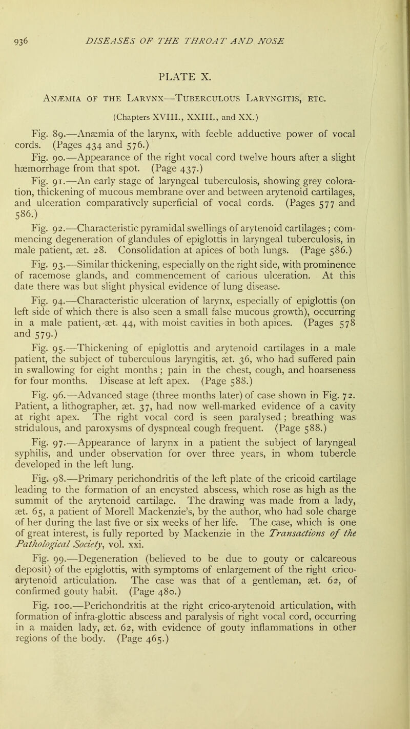 PLATE X. Anaemia of the Larynx—Tuberculous Laryngitis, etc. (Chapters XVIII., XXIII., and XX.) Fig. 89.—Anaemia of the larynx, with feeble adductive power of vocal cords. (Pages 434 and 576.) Fig. 90.—Appearance of the right vocal cord twelve hours after a slight haemorrhage from that spot. (Page 437.) Fig. 91.—An early stage of laryngeal tuberculosis, showing grey colora- tion, thickening of mucous membrane over and between arytenoid cartilages, and ulceration comparatively superficial of vocal cords. (Pages 577 and 586.) Fig. 92.—Characteristic pyramidal swellings of arytenoid cartilages; com- mencing degeneration of glandules of epiglottis in laryngeal tuberculosis, in male patient, set. 28. Consolidation at apices of both lungs. (Page 586.) Fig. 93.—Similar thickening, especially on the right side, with prominence of racemose glands, and commencement of carious ulceration. At this date there was but slight physical evidence of lung disease. Fig. 94.—Characteristic ulceration of larynx, especially of epiglottis (on left side of which there is also seen a small false mucous growth), occurring in a male patient,-set. 44, with moist cavities in both apices. (Pages 578 and 579.) Fig. 95.—Thickening of epiglottis and arytenoid cartilages in a male patient, the subject of tuberculous laryngitis, aet. 36, who had suffered pain in swallowing for eight months; pain in the chest, cough, and hoarseness for four months. Disease at left apex. (Page 588.) Fig. 96.—Advanced stage (three months later) of case shown in Fig. 72. Patient, a lithographer, aet. 37, had now well-marked evidence of a cavity at right apex. The right vocal cord is seen paralysed; breathing was stridulous, and paroxysms of dyspnoeal cough frequent. (Page 588.) Fig- 97-—Appearance of larynx in a patient the subject of laryngeal syphilis, and under observation for over three years, in whom tubercle developed in the left lung. Fig. 98.—Primary perichondritis of the left plate of the cricoid cartilage leading to the formation of an encysted abscess, which rose as high as the summit of the arytenoid cartilage. The drawing was made from a lady, aet. 65, a patient of Morell Mackenzie's, by the author, who had sole charge of her during the last five or six weeks of her life. The case, which is one of great interest, is fully reported by Mackenzie in the Transactions of the Pathological Society^ vol. xxi. Fig. 99.—Degeneration (believed to be due to gouty or calcareous deposit) of the epiglottis, with symptoms of enlargement of the right crico- arytenoid articulation. The case was that of a gentleman, aet. 62, of confirmed gouty habit. (Page 480.) Fig. 100.—Perichondritis at the right crico-arytenoid articulation, with formation of infra-glottic abscess and paralysis of right vocal cord, occurring in a maiden lady, aet. 62, with evidence of gouty inflammations in other regions of the body. (Page 465.)