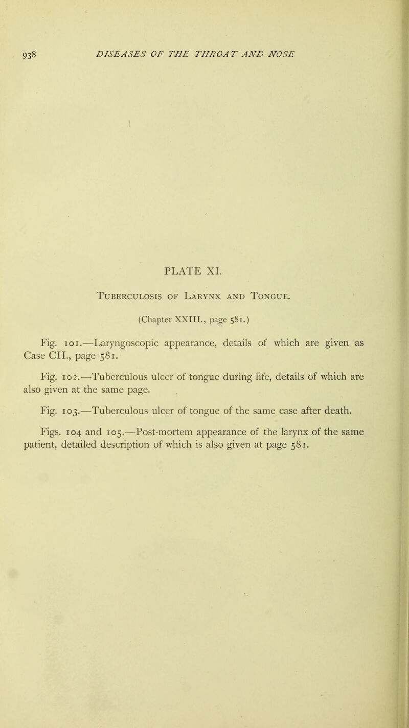 PLATE XL Tuberculosis of Larynx and Tongue. (Chapter XXIII., page 581.) Fig. 101.—Laryngoscopic appearance, details of which are given as Case CIL, page 581. Fig. 102.—Tuberculous ulcer of tongue during life, details of which are also given at the same page. Fig. 103.—Tuberculous ulcer of tongue of the same case after death. Figs. 104 and 105.—Post-mortem appearance of the larynx of the same patient, detailed description of which is also given at page 581.