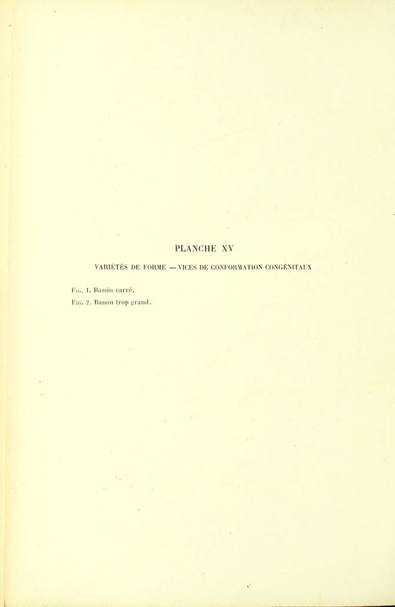 VARIÉTÉS DE FORME — VICES DE CONFOHMATinN CONGÉNITAUX FiG. I. Dassin caiTÔ. FiG. 2. Bassin trop ^ratid. 1