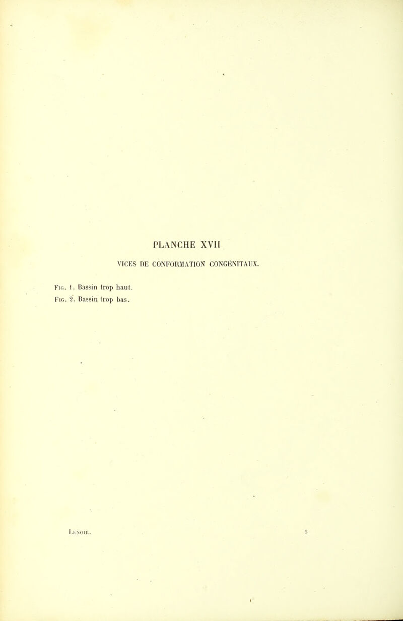 VICES DE CONFORMATION CONGÉNITAUX. FiG. i. Bassin trop haut. FiG. 2. Bassin trop bas. I-ENOIR.