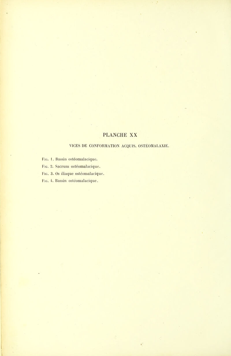 VICES DE CONFORMATION ACQUIS. OSTEOMALAXIE. FiG. I. Bassin ostéomalacique. FiG. 2. Sacrum ostéomalacique. FiG. 3. Os iliaque ostéomalacique. FiG. 4. Bassin ostéomalacique.