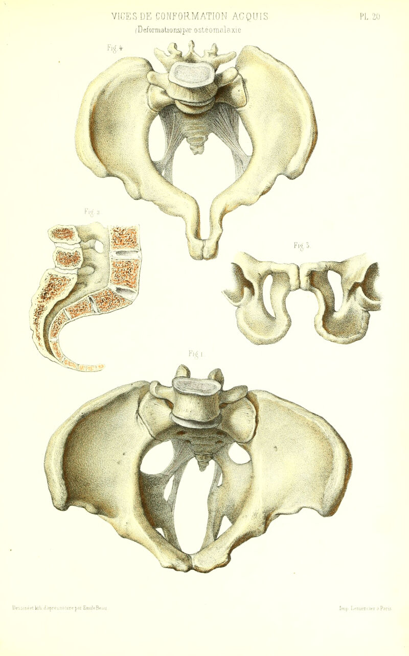 VIGESDE CONFORMATION AGQLTIS PL.20 (Deformationsipar osteomalaxie lJf-:7iii''K Util dtipre;. ii^itiiri: P'ii EuiilcBedU Inip Lriiiei < lei (T Pans