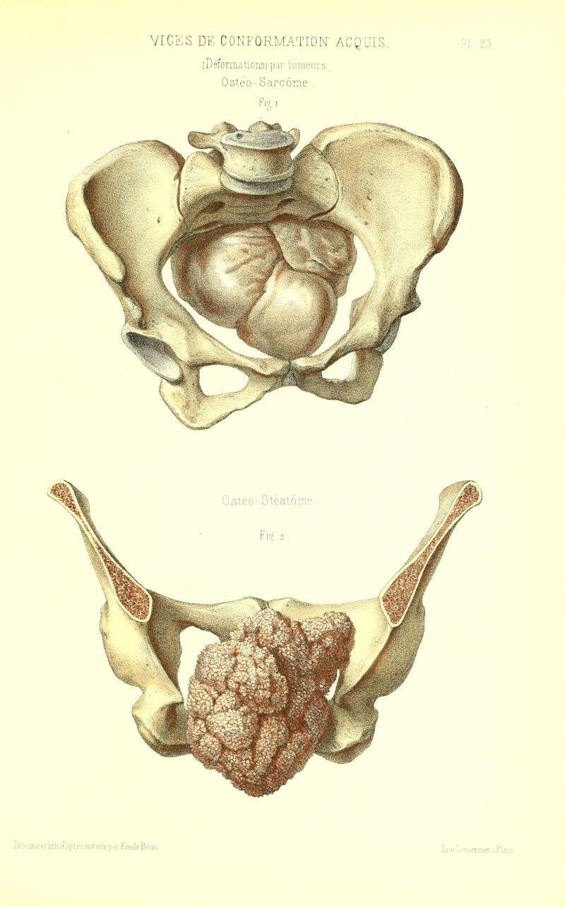 VICES DE CONFORMATION ACQUIS. !-'L 23 (Déformations) prir tiinieui s Osteo-Sarcôra.e . Ijcssuiesllitji ir,i[ire:; nature pm KiriileB(;;iu luih IjHiiioTcifr.iPui'i^