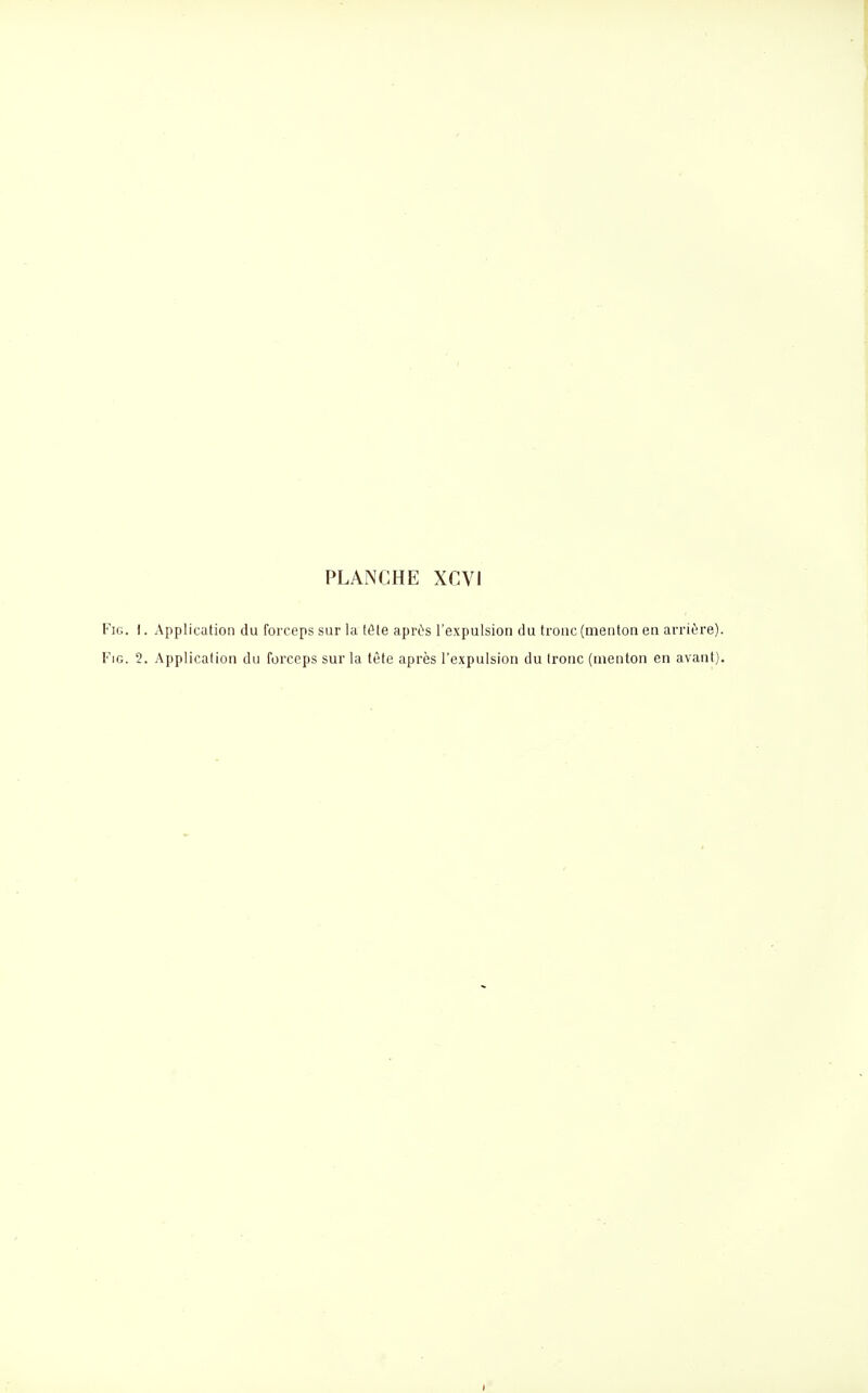 FiG. I. Application du forceps sur la tôle après l'expulsion du tronc (menton en arrière). FiG. 2. Application du forceps sur la tête après l'expulsion du tronc (menton en avant).