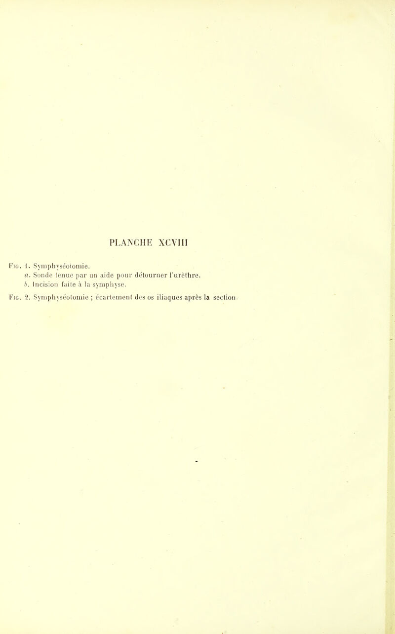 FiG. i. Symphyséoiomie. a. Sonde tenue par un aide pour détourner l'urètlire. II. Incision fuite à la symphyse. FiG. 2. Synipliyséolomie ; écartement des os iliaques aprûs la section.