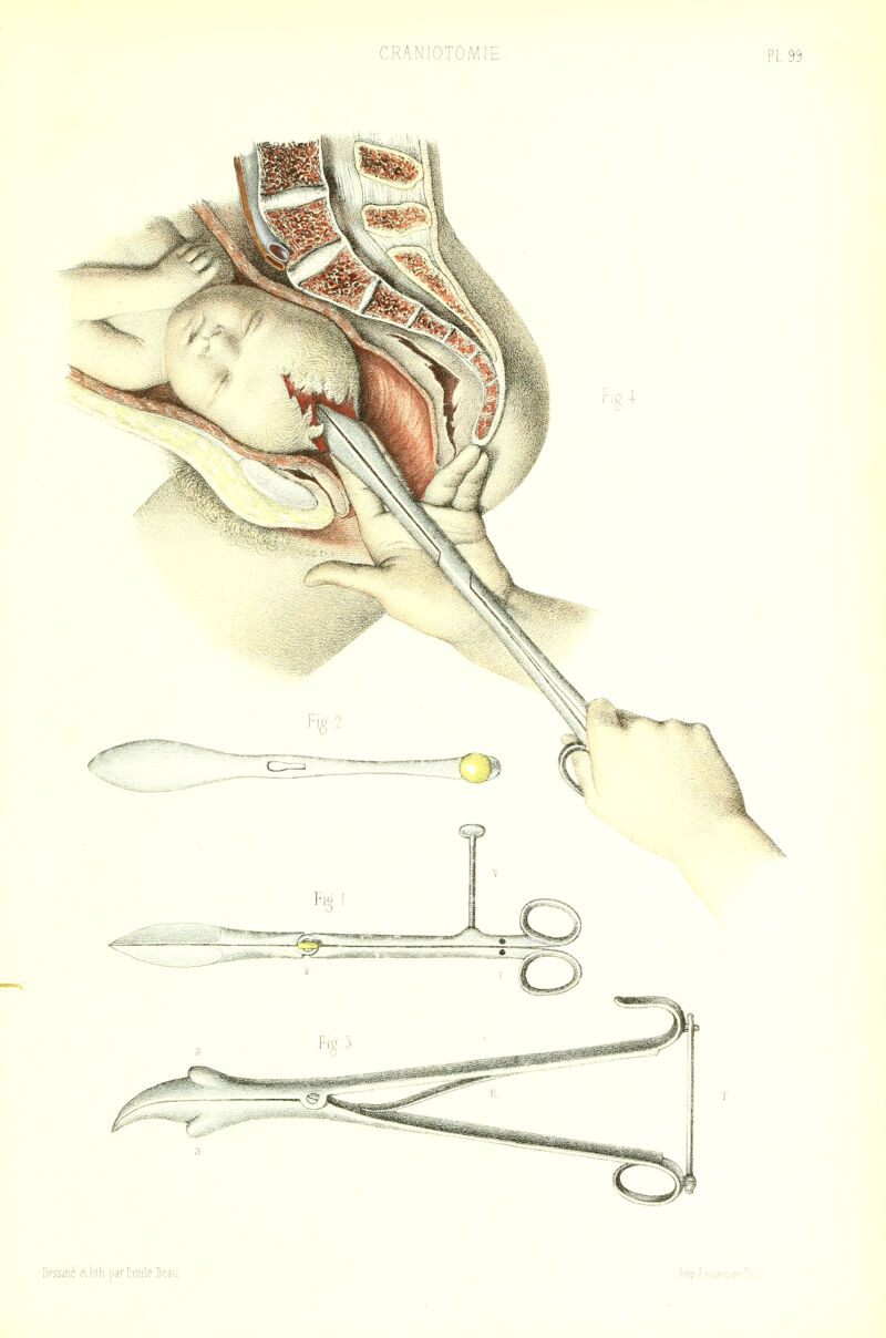 CRANIOTOMIE PL 99 Dessiné eiliih jMrEinilcBeau Inip Iciiicrcicr