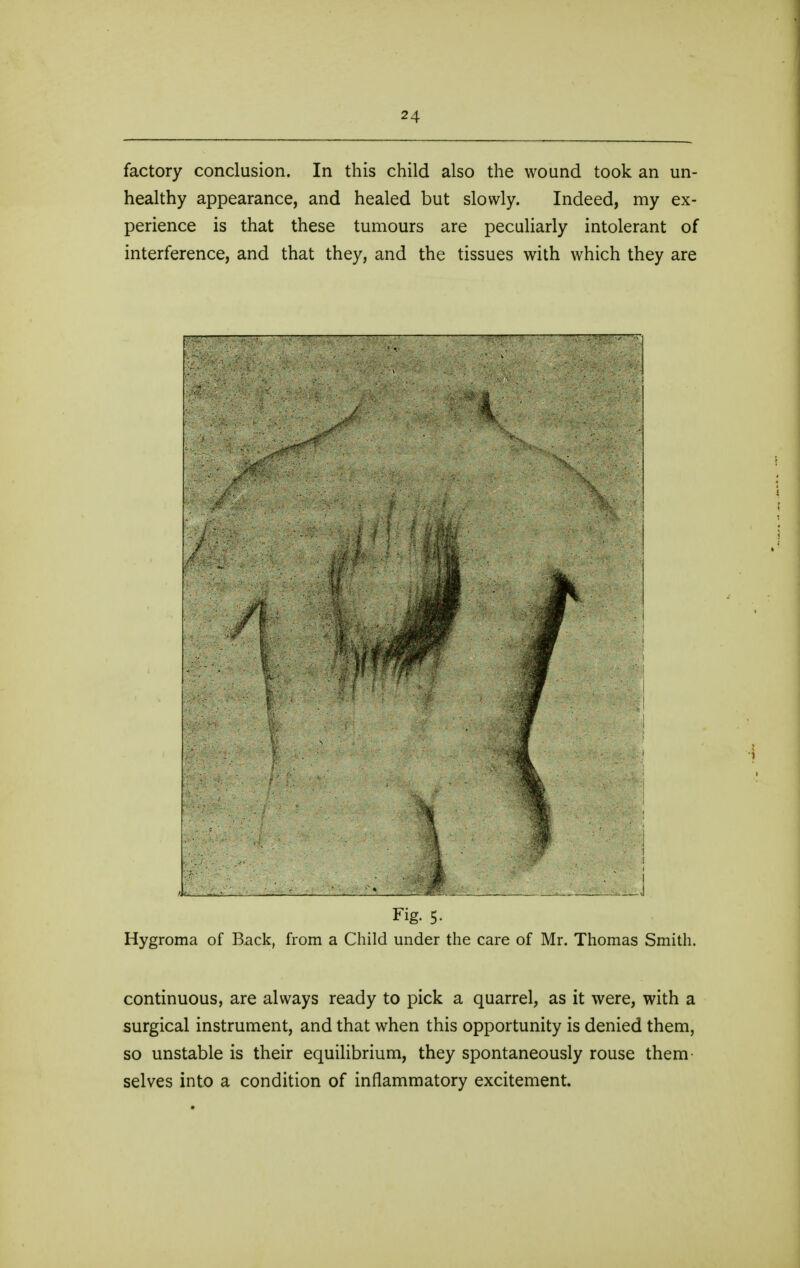 factory conclusion. In this child also the wound took an un- healthy appearance, and healed but slowly. Indeed, my ex- perience is that these tumours are peculiarly intolerant of interference, and that they, and the tissues with which they are Fig. 5. Hygroma of Back, from a Child under the care of Mr. Thomas Smith. continuous, are always ready to pick a quarrel, as it were, with a surgical instrument, and that when this opportunity is denied them, so unstable is their equilibrium, they spontaneously rouse them selves into a condition of inflammatory excitement.