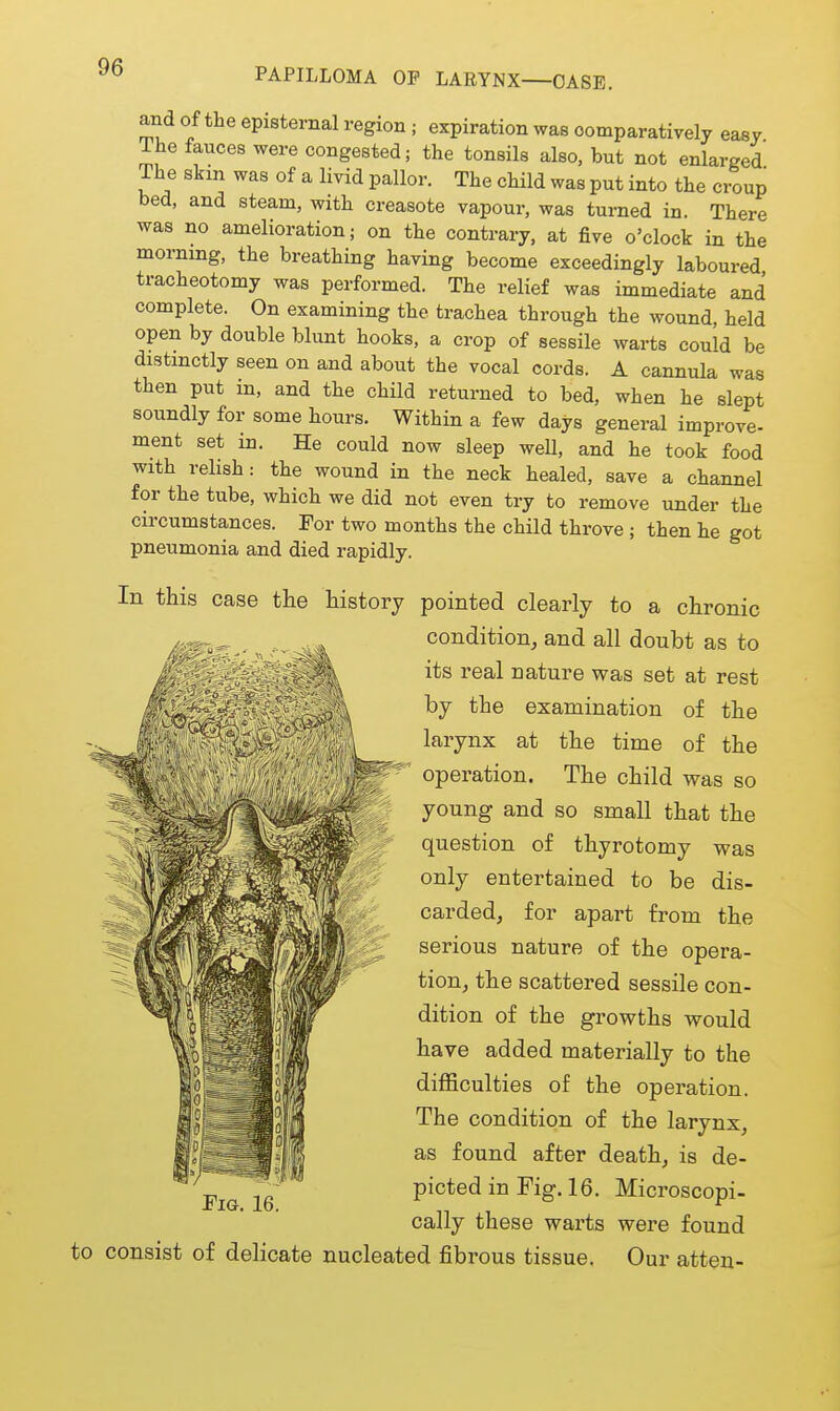 and of the episternal region ; expiration was comparatively easy The fauces were congested; the tonsils also, but not enlarged The skm was of a livid pallor. The child was put into the croup bed, and steam, with creasote vapour, was turned in. There was no amelioration; on the contrary, at five o'clock in the morning, the breathing having become exceedingly laboured tracheotomy was performed. The relief was immediate and complete. On examining the trachea through the wound, held open by double blunt hooks, a crop of sessile warts could be distinctly seen on and about the vocal cords. A cannula was then put in, and the child returned to bed, when he slept soundly for some hours. Within a few days general improve- ment set in. He could now sleep well, and he took food with relish: the wound in the neck healed, save a channel for the tube, which we did not even try to remove under the circumstances. For two months the child throve; then he got pneumonia and died rapidly. In this case the history pointed clearly to a chronic condition,, and all doubt as to its real nature was set at rest by the examination of the larynx at the time of the operation. The child was so young and so small that the question of thyrotomy was only entertained to be dis- carded, for apart from the serious nature of the opera- tion, the scattered sessile con- dition of the growths would have added materially to the difficulties of the operation. The condition of the larynx, as found after death, is de- picted in Fig. 16. Microscopi- cally these warts were found to consist of delicate nucleated fibrous tissue. Our atten-