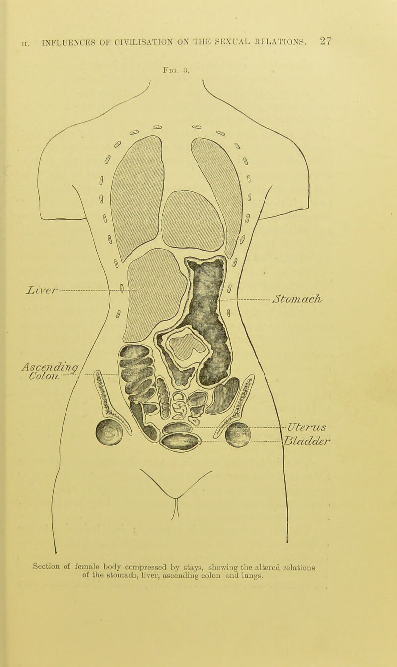 Section of female body compressed by stayH, allowing the altered relations of tlie Blomacli, liver, ascending colon and lungs.