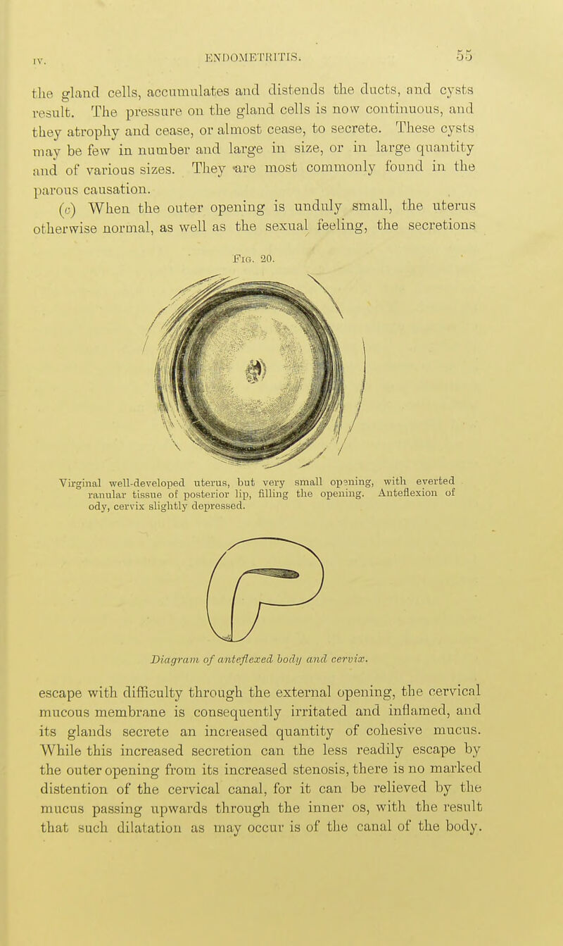 the gland cells, accumulates and distends the ducts, and cysts result. The pressure on the gland cells is now continuous, and they atrophy and cease, or almost cease, to secrete. These cysts may be few in number and large in size, or in large quantity and of various sizes. They 'are most commonly found in the parous causation. (c) When the outer opening is unduly small, the uterus otherwise normal, as well as the sexual feeling, the secretions Fig. 20. Virginal well-developed uterus, but very small op3ning, with everted ranular tissue of posterior lip, filling the opening. Anteflexion of ody, cervix slightly depressed. Diagram of anteflexed, bodi/ and cervix. escape with difficulty through the external opening, the cervical mucous membrane is consequently irritated and inflamed, and its glands secrete an increased quantity of cohesive mucus. While this increased secretion can the less readily escape by the outer opening from its increased stenosis, there is no marked distention of the cervical canal, for it can be relieved by the mucus passing upwards through the inner os, with the result that such dilatation as may occur is of tlie canal of the body.