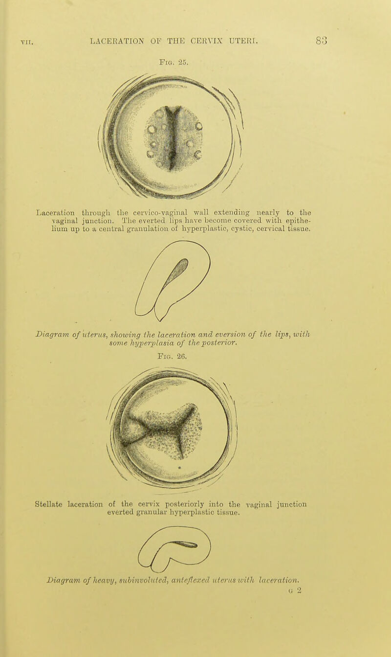 Fig. '25. Lacenition tlivoiigli the cervico-vaginal wall extending nearly to the vaginal junction. The everted lips have become covered with epithe- lium up to a central granulation of hyperplastic, cystic, cervical tissue. Diagram of uterus, showing the lacm-ation and eversion of the lips, with some hyper2Jlasia of the posterior. Fig. 26. Diagram of heavy, suhinvoluted, antcflexed atcrns wUli laceration. u 2